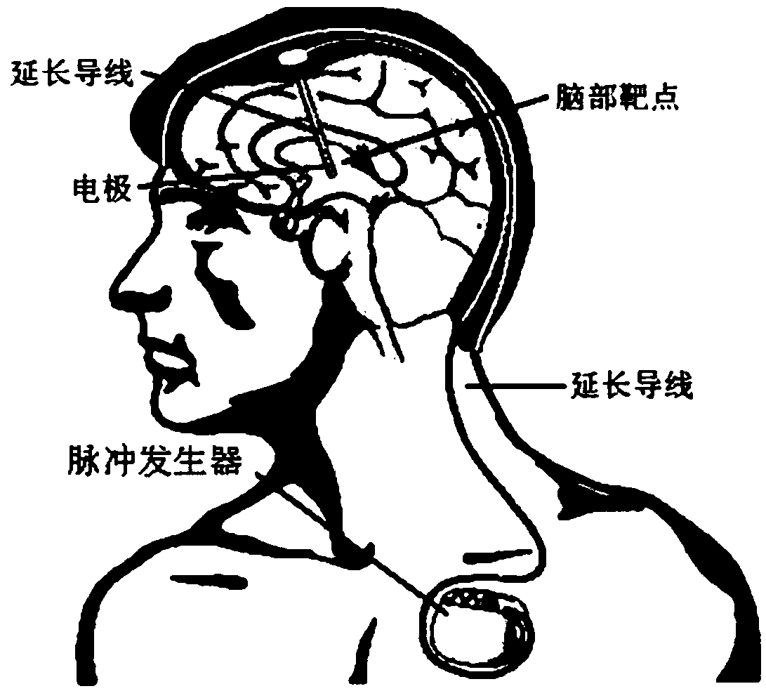 Electricity monitoring method and electric quantity monitoring system of a brain pacemaker