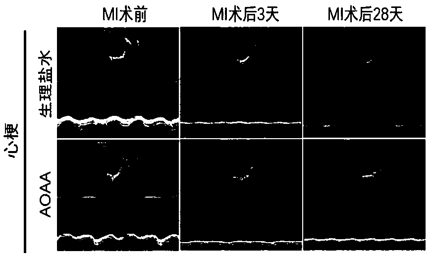 Application of aminooxyacetic acid (AOAA) in preparation of drug for preventing or treating myocardial infarction