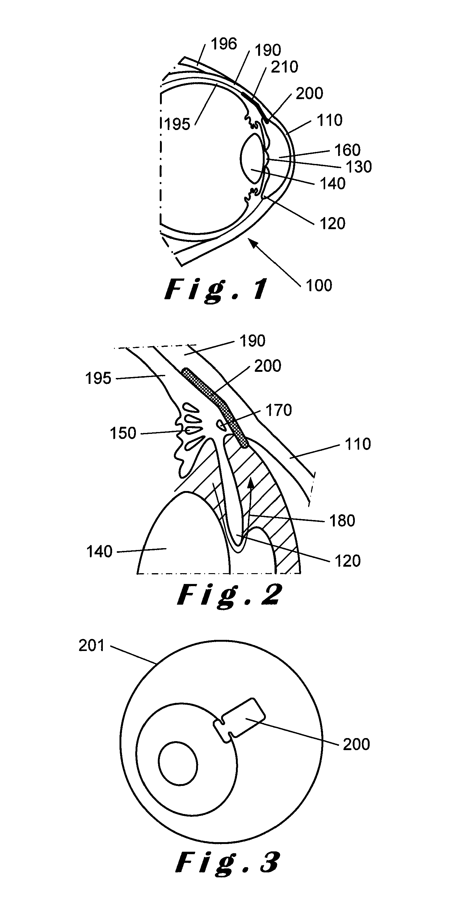 Device and method for glaucoma management and treatment