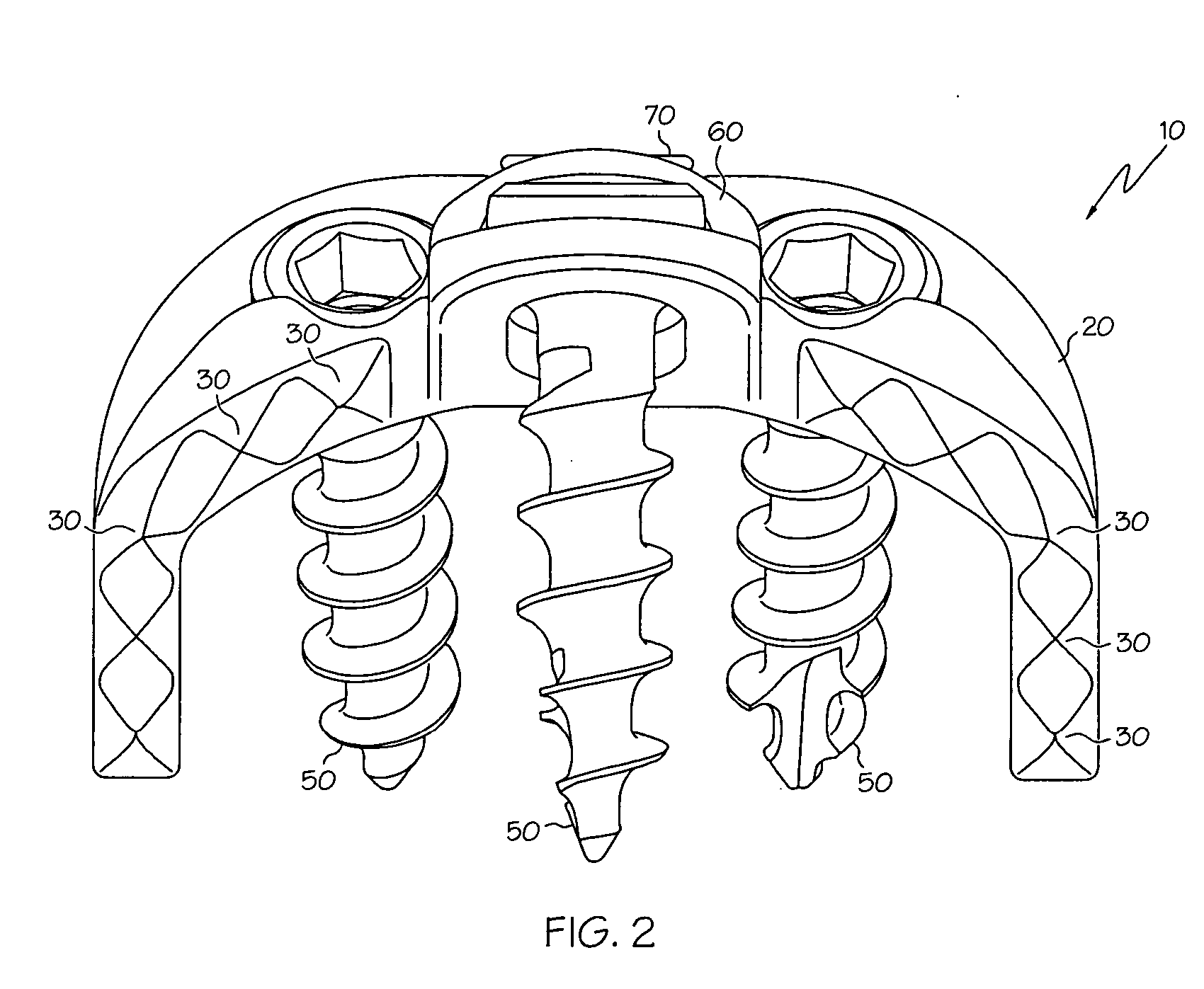 Implant subsidence control