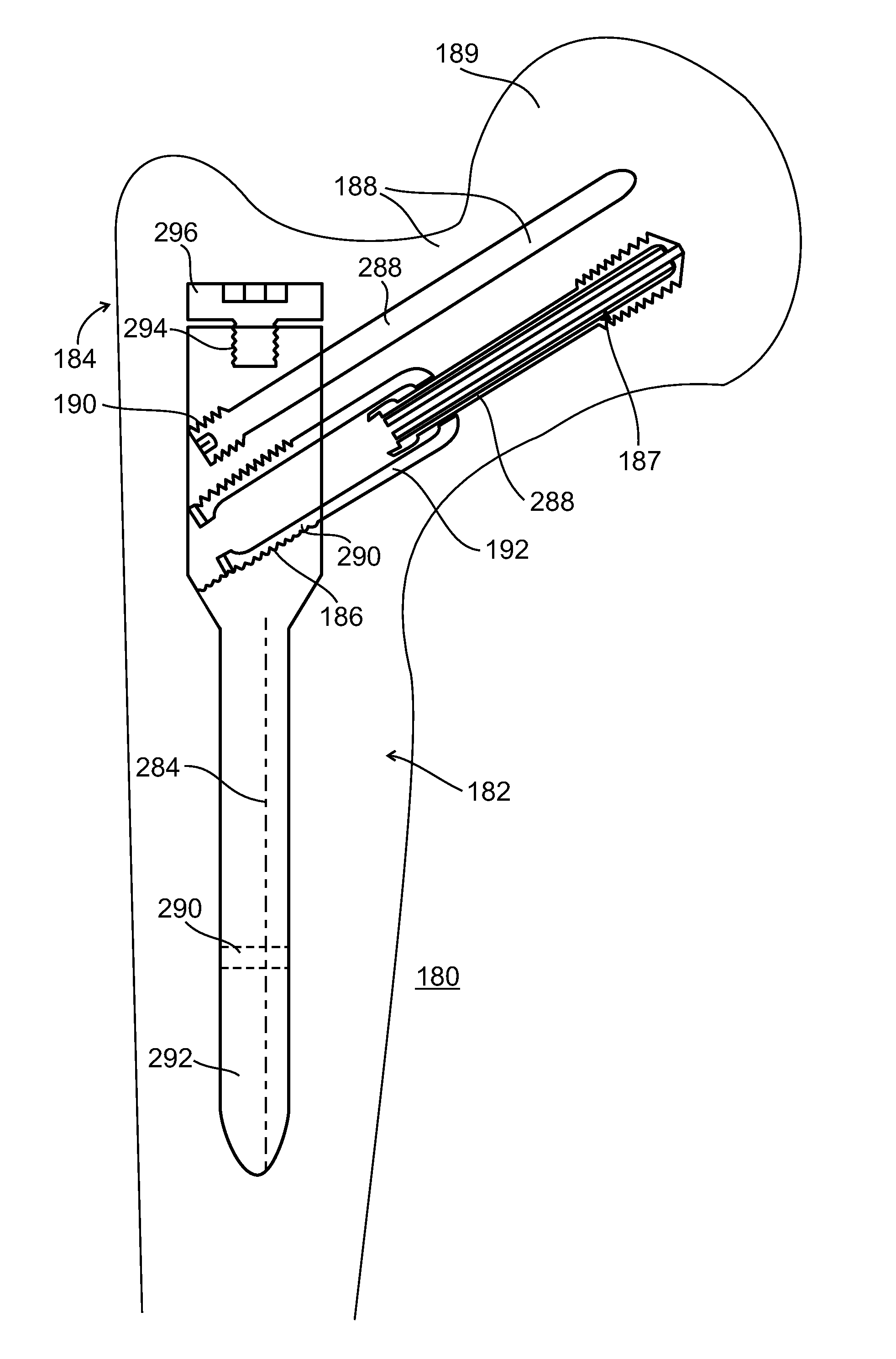 Composite material bone implant