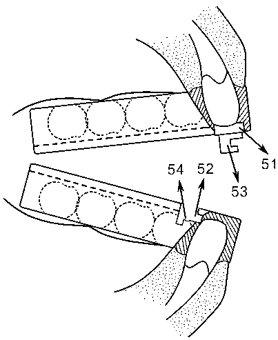 Underjaw multiposition adjusting snore-ceasing equipment