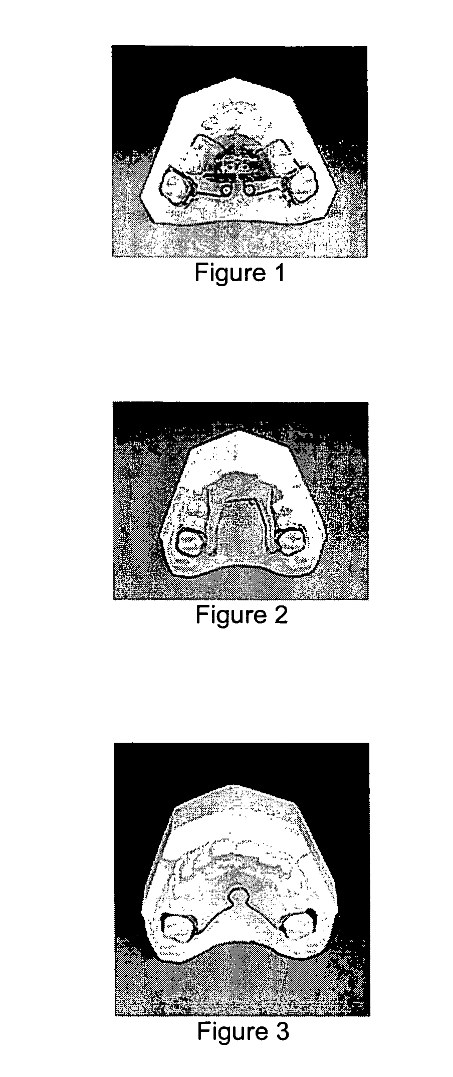 Two-phase invisible orthodontics