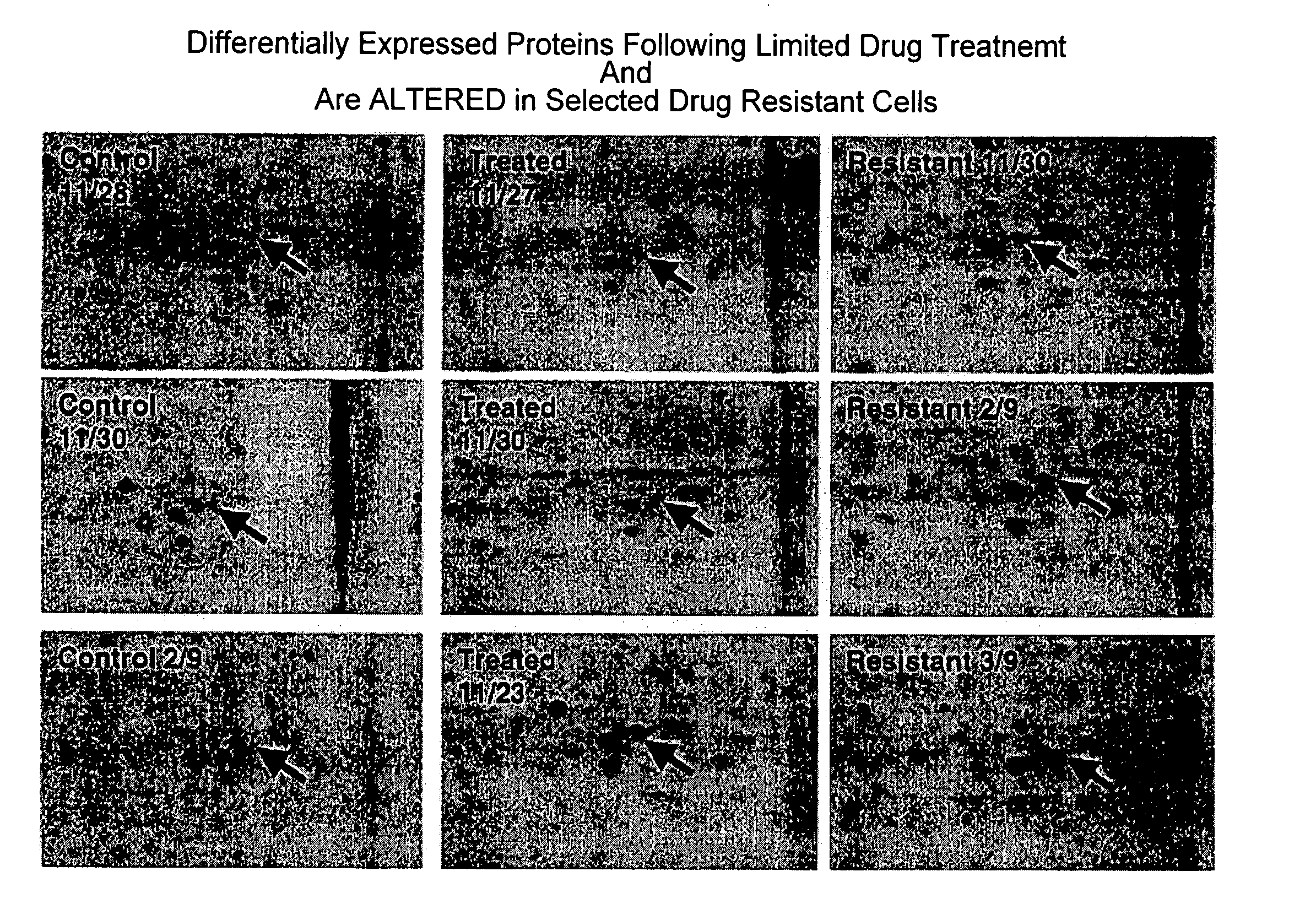 Triosephosphate isomerase directed diagnostics and therapeutics for multidrug resistant neoplastic disease