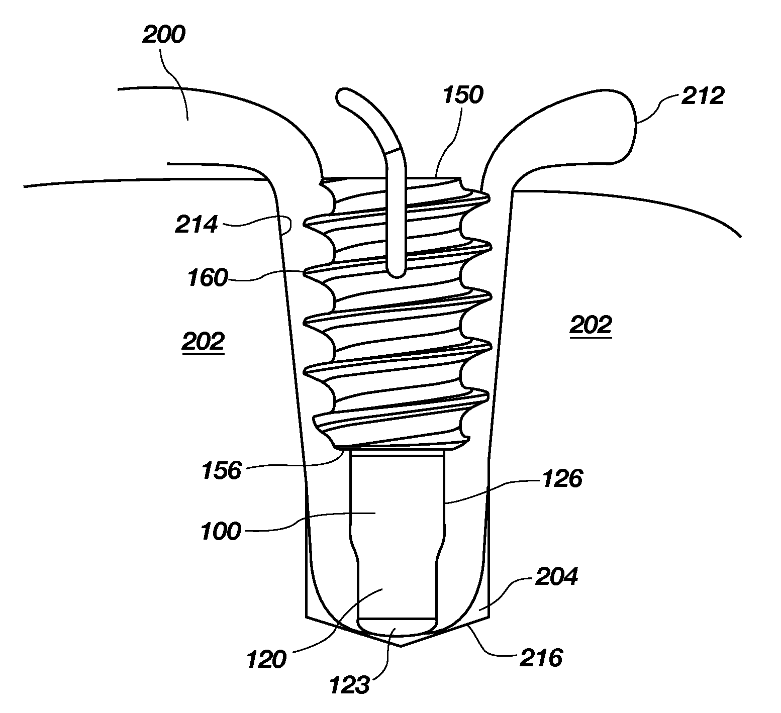 Tenodesis system