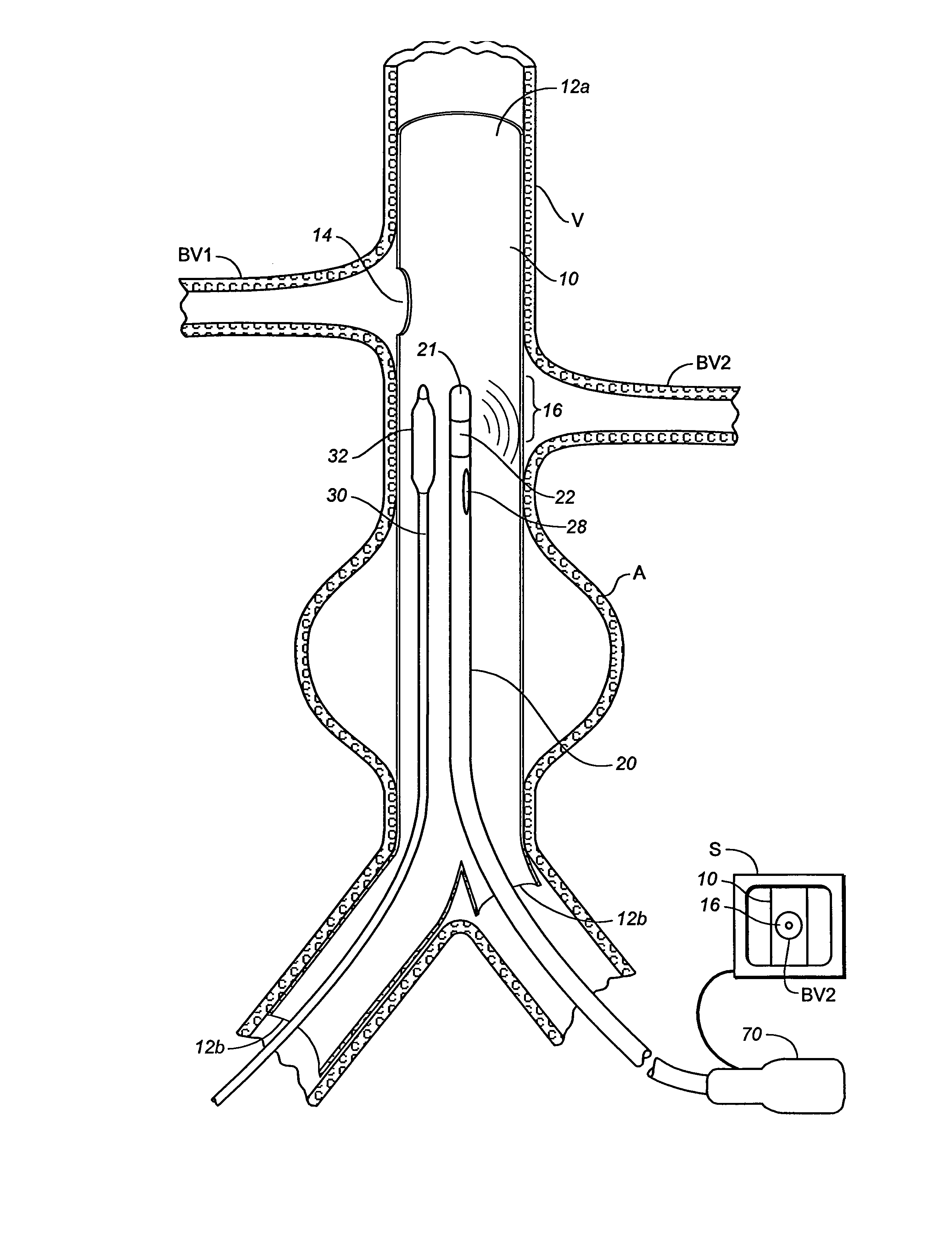 Multiple Branch Tubular Prosthesis and Methods