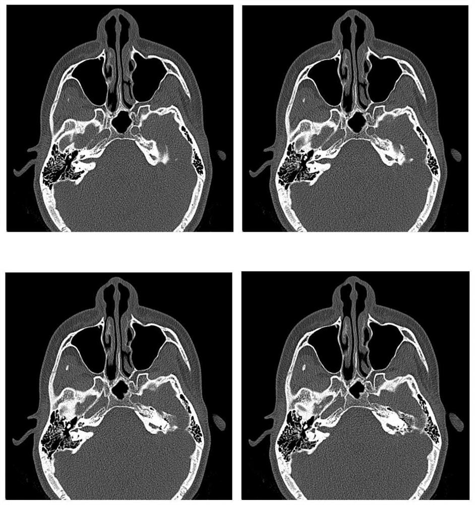 Multi-section medical image compression method based on three-dimensional discrete wavelet transform