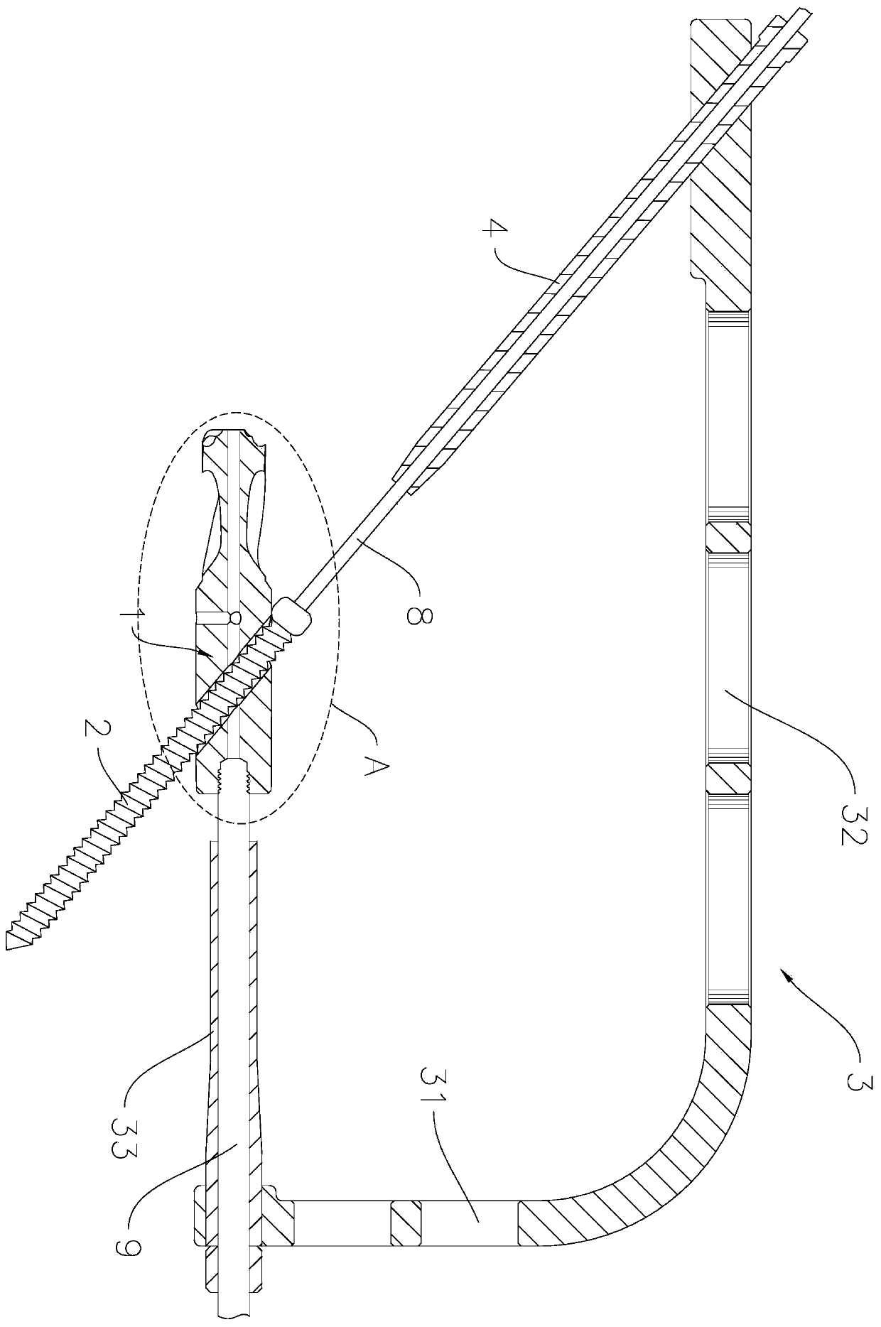 Novel unilateral locking lumbosacral vertebrae axial fusion internal fixing system