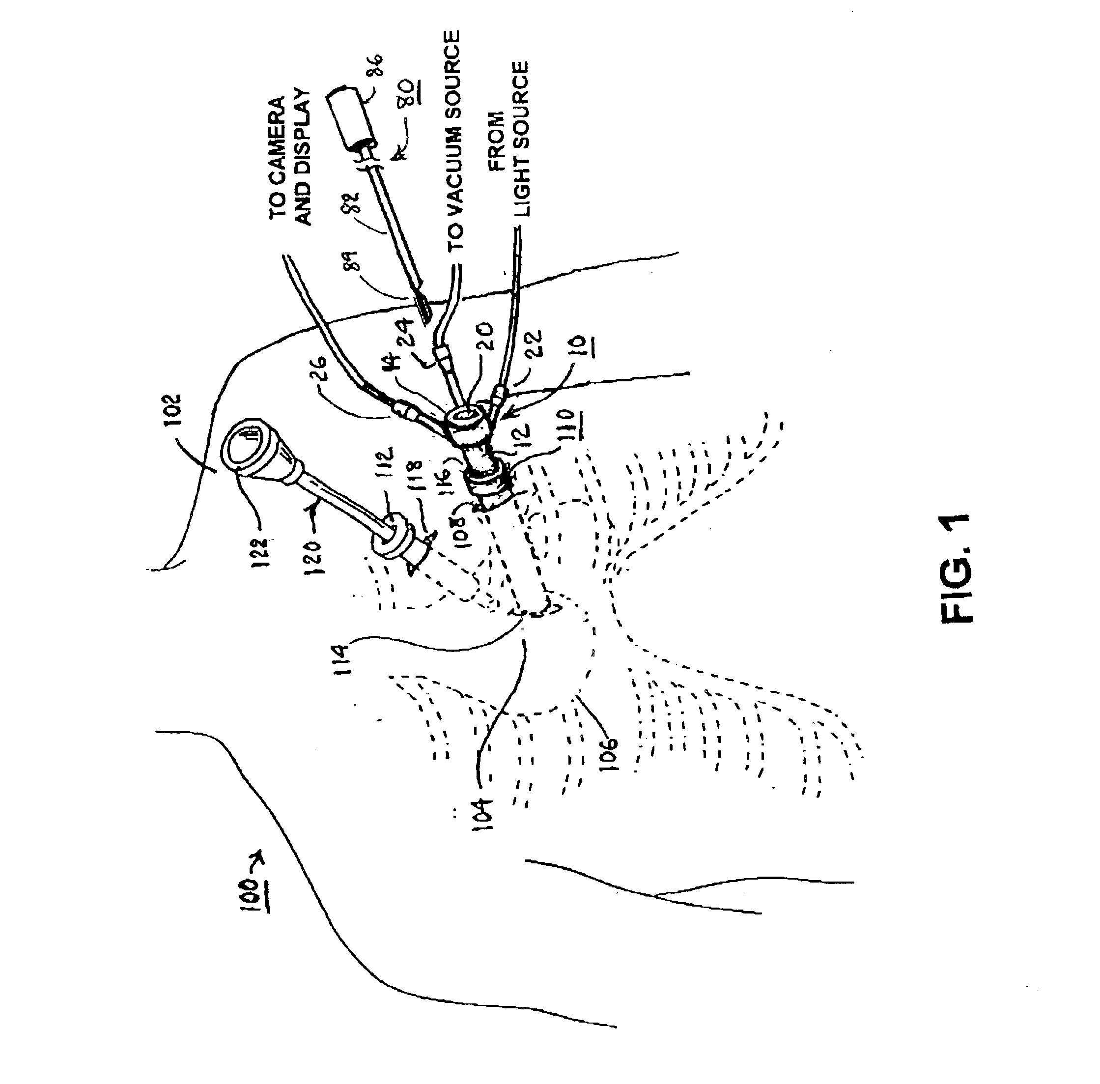 Methods and apparatus for accessing and stabilizing an area of the heart