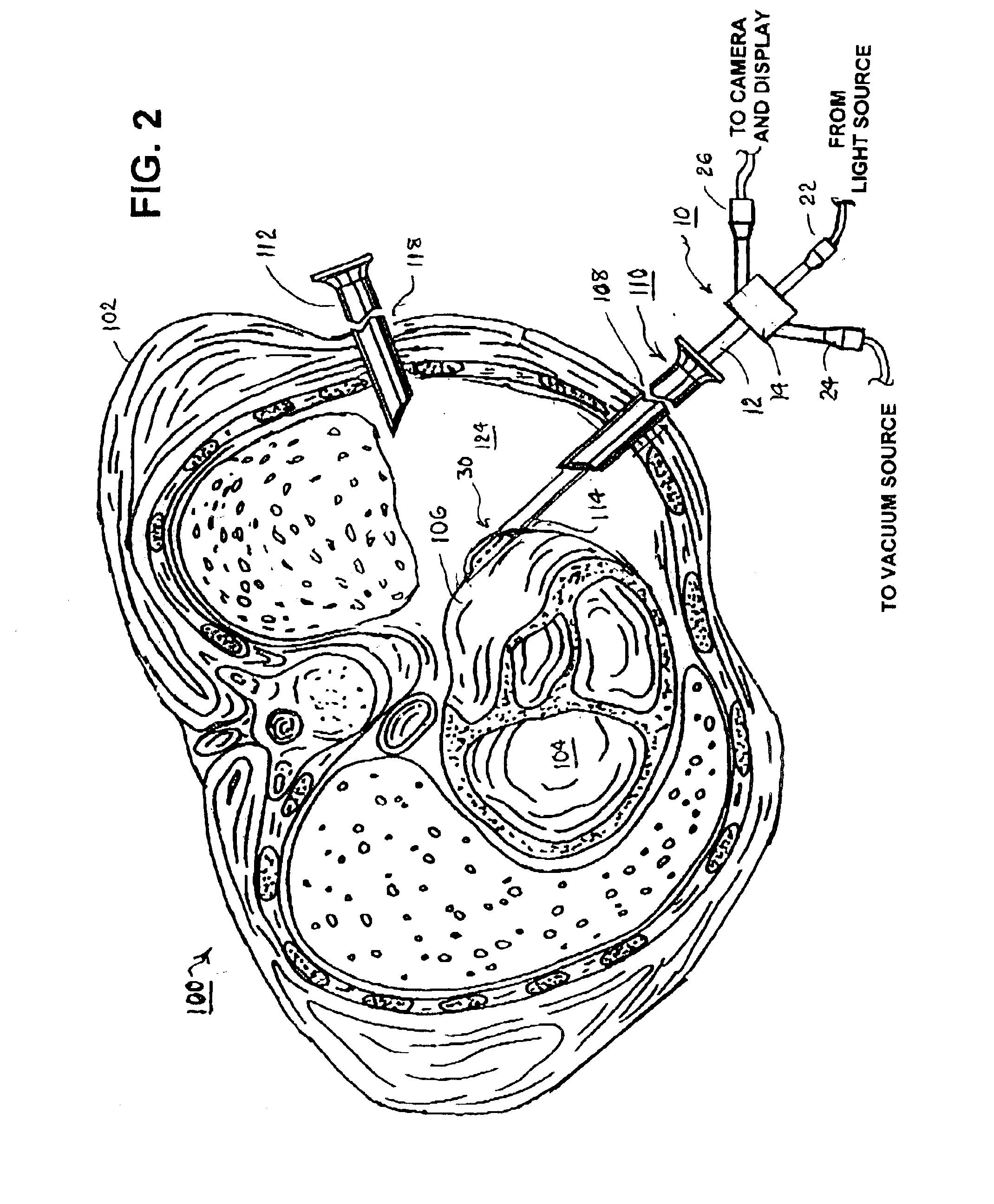 Methods and apparatus for accessing and stabilizing an area of the heart