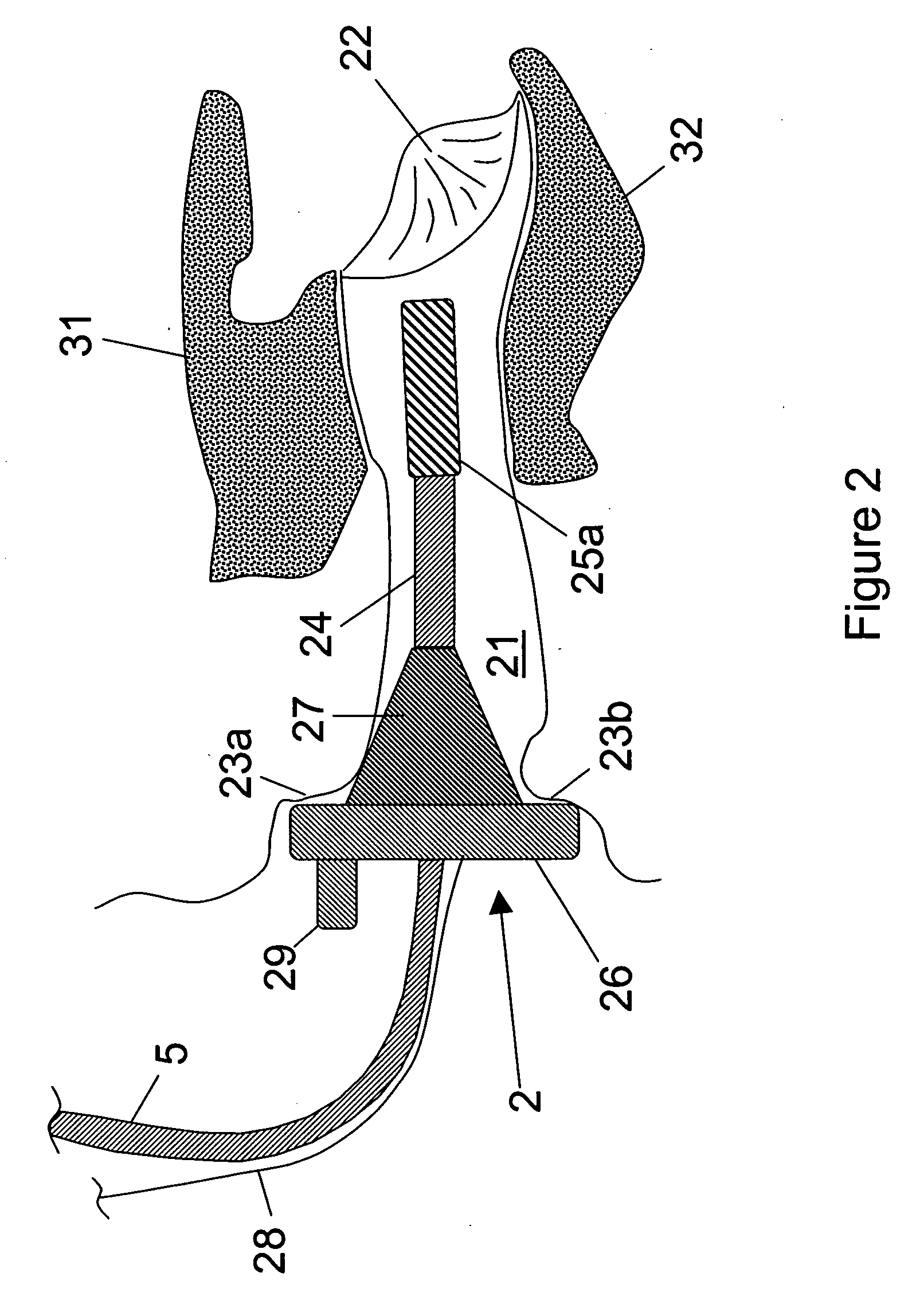 Apparatus, system and method for detecting and treating airway obstructive conditions during sleep