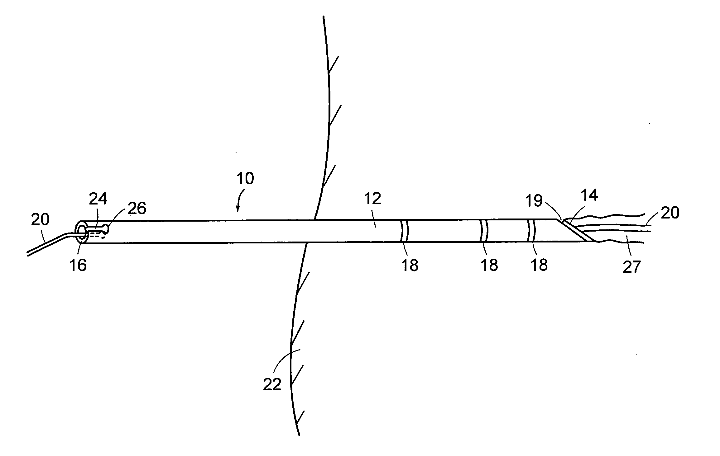 Apparatus and method for establishing access to the body