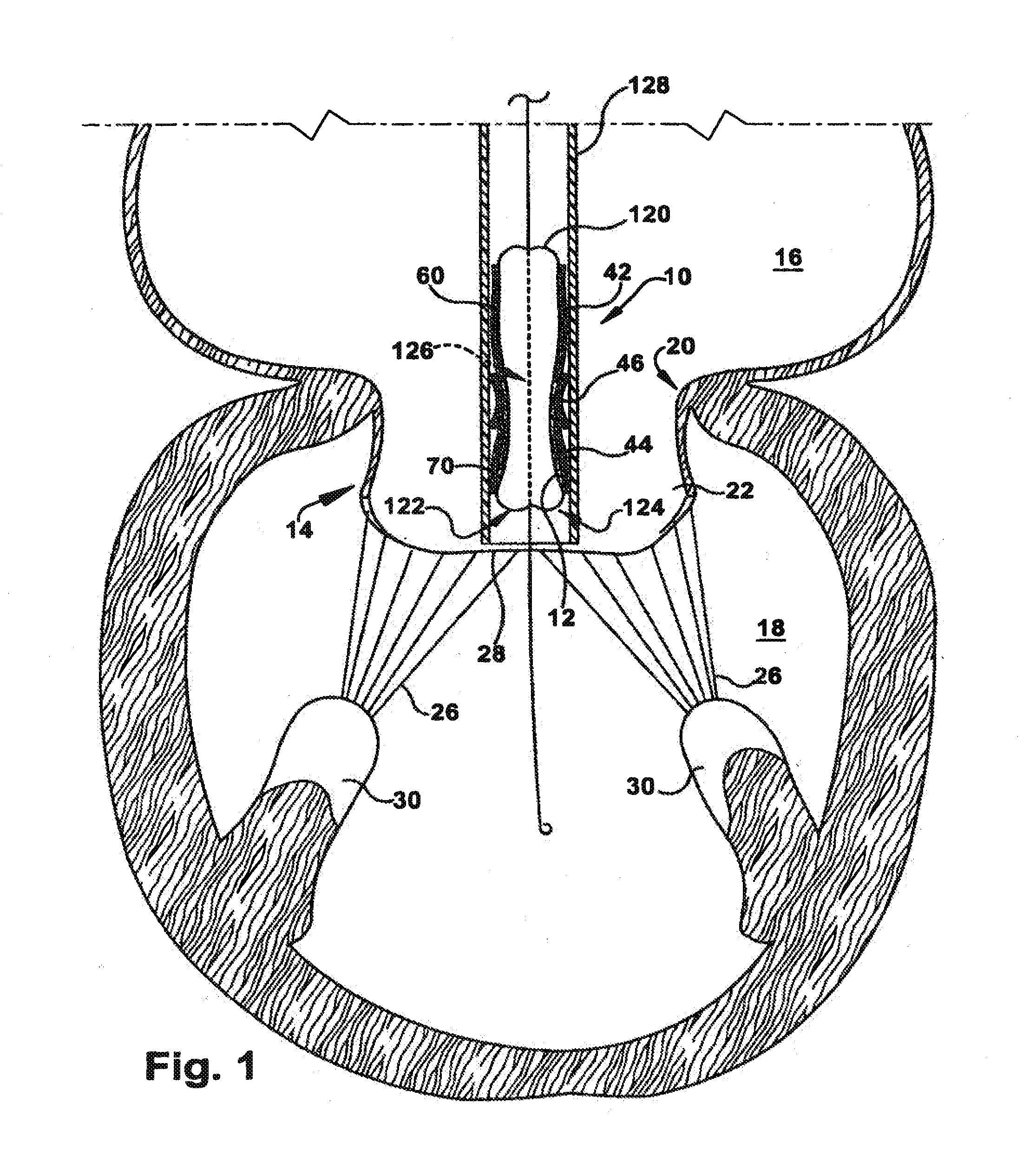 Methods for replacing a cardiac valve