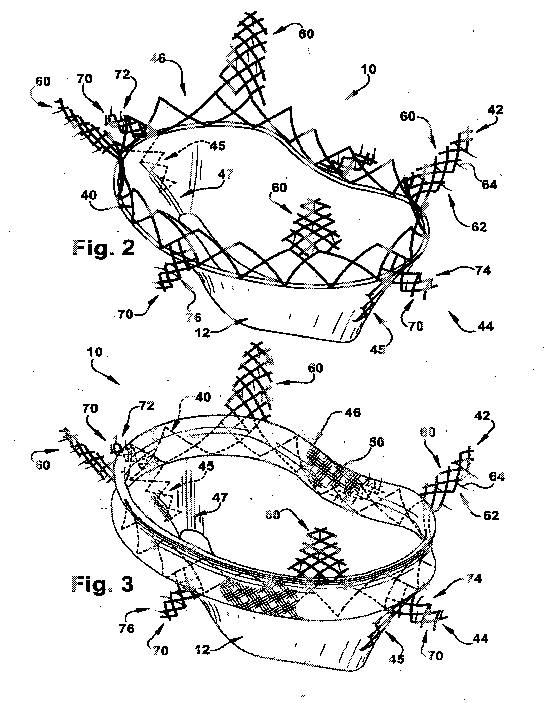 Methods for replacing a cardiac valve