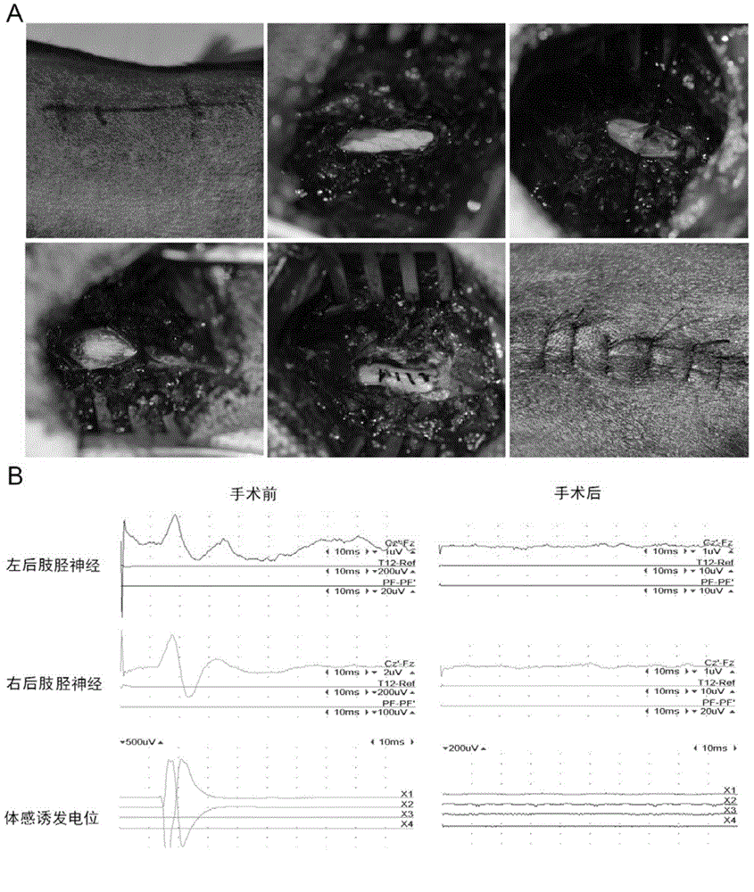 Application of cetuximab and collagen scaffold loaded with cetuximab to preparation of drug for repairing spinal cord injury