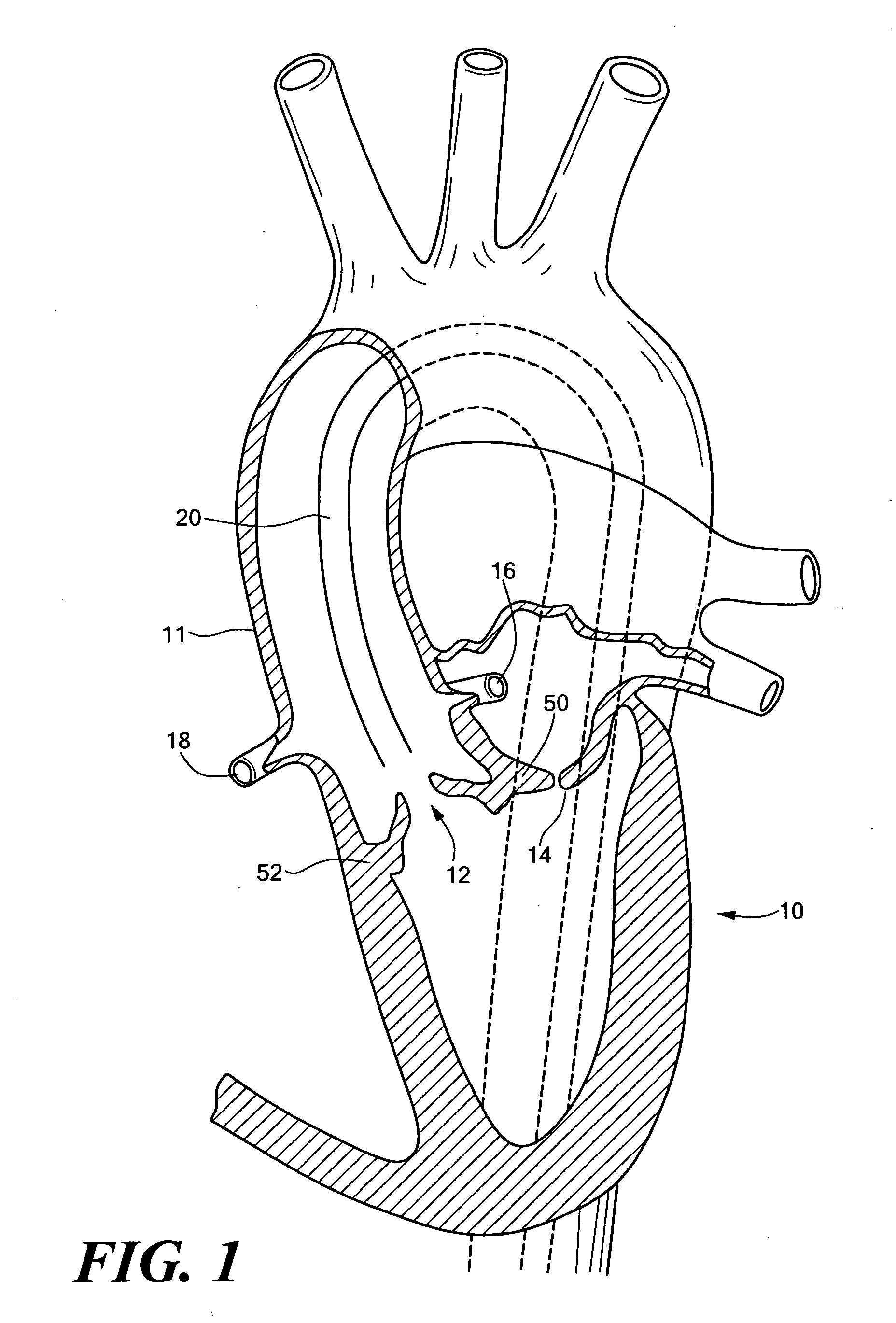 Endovascular tissue removal device