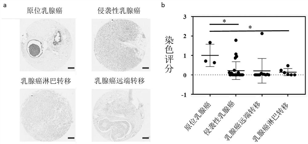 Application of HTR6 in diagnosis and prognosis of breast cancer