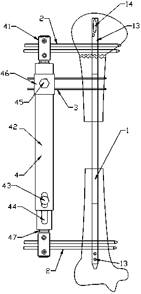 A bone-handling device for humeral large-segment bone defect