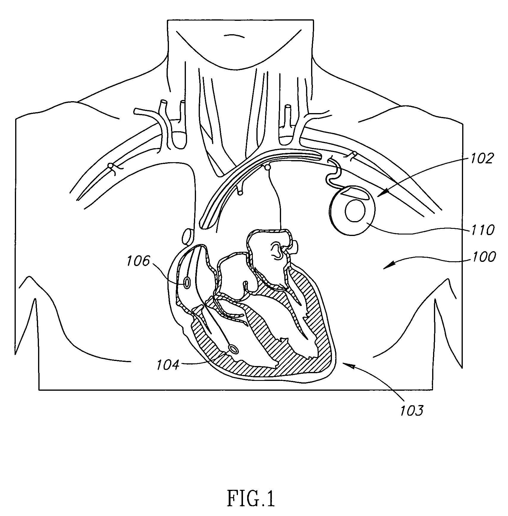 Bio-impedance apparatus and method