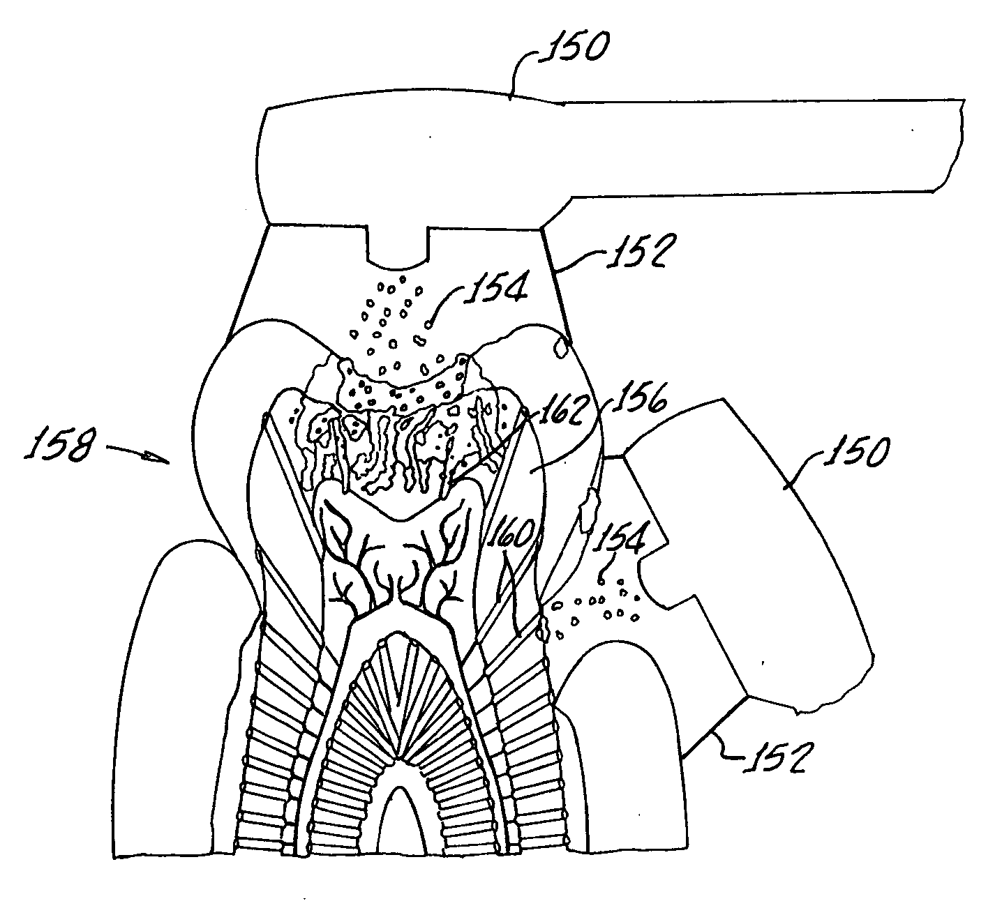 Method and apparatus for treating dentin sensitivity