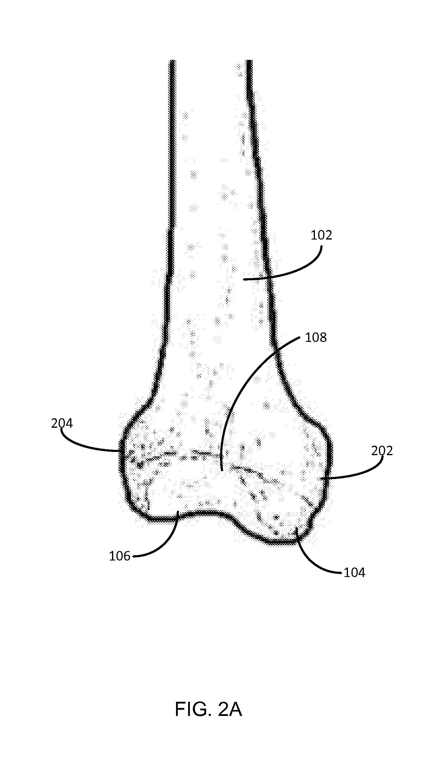 Method for knee resection alignment approximation in knee replacement procedures