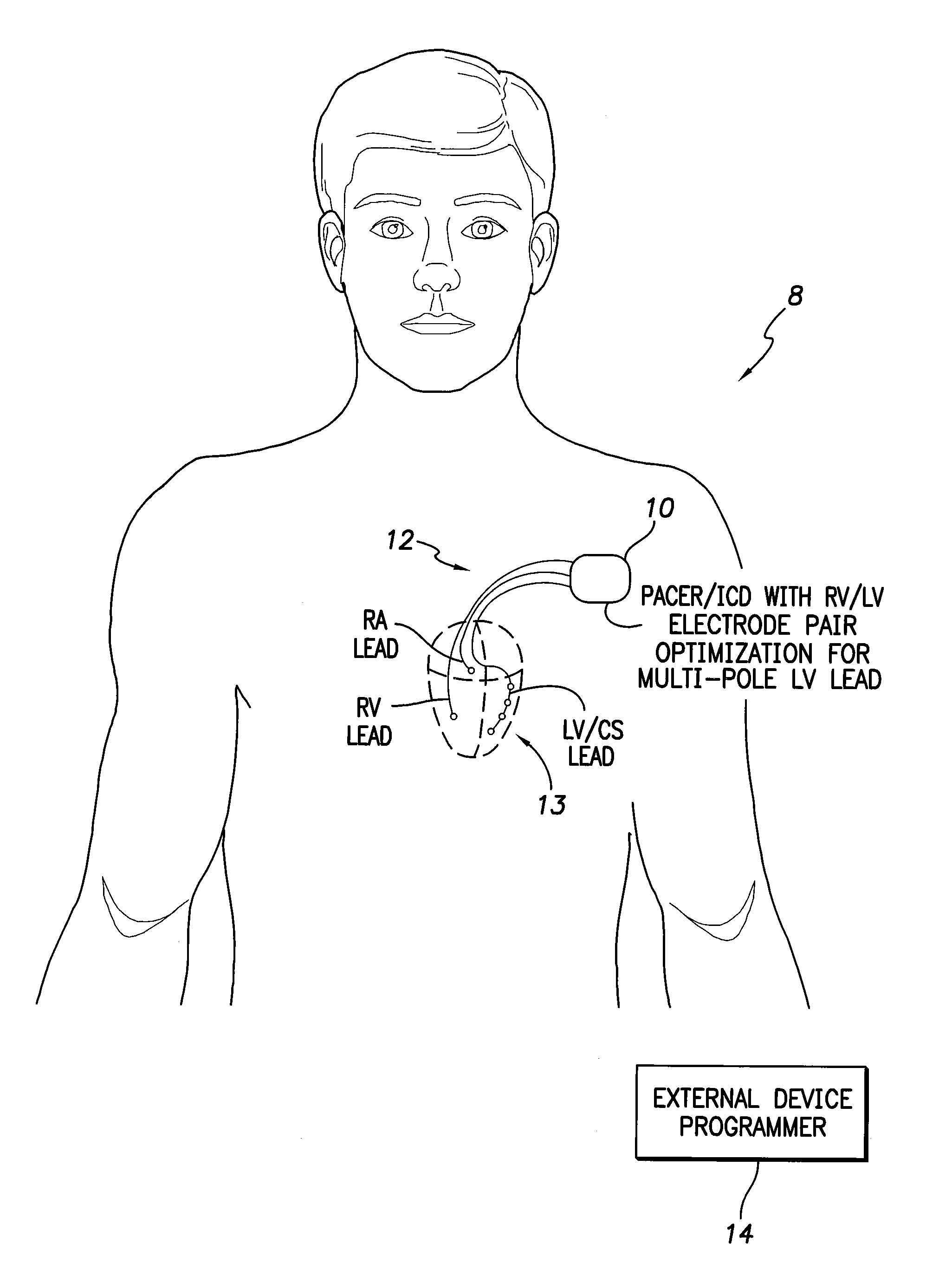 Sytems and methods for determining optimal electrode pairs for use in biventricular pacing using multi-pole ventricular leads