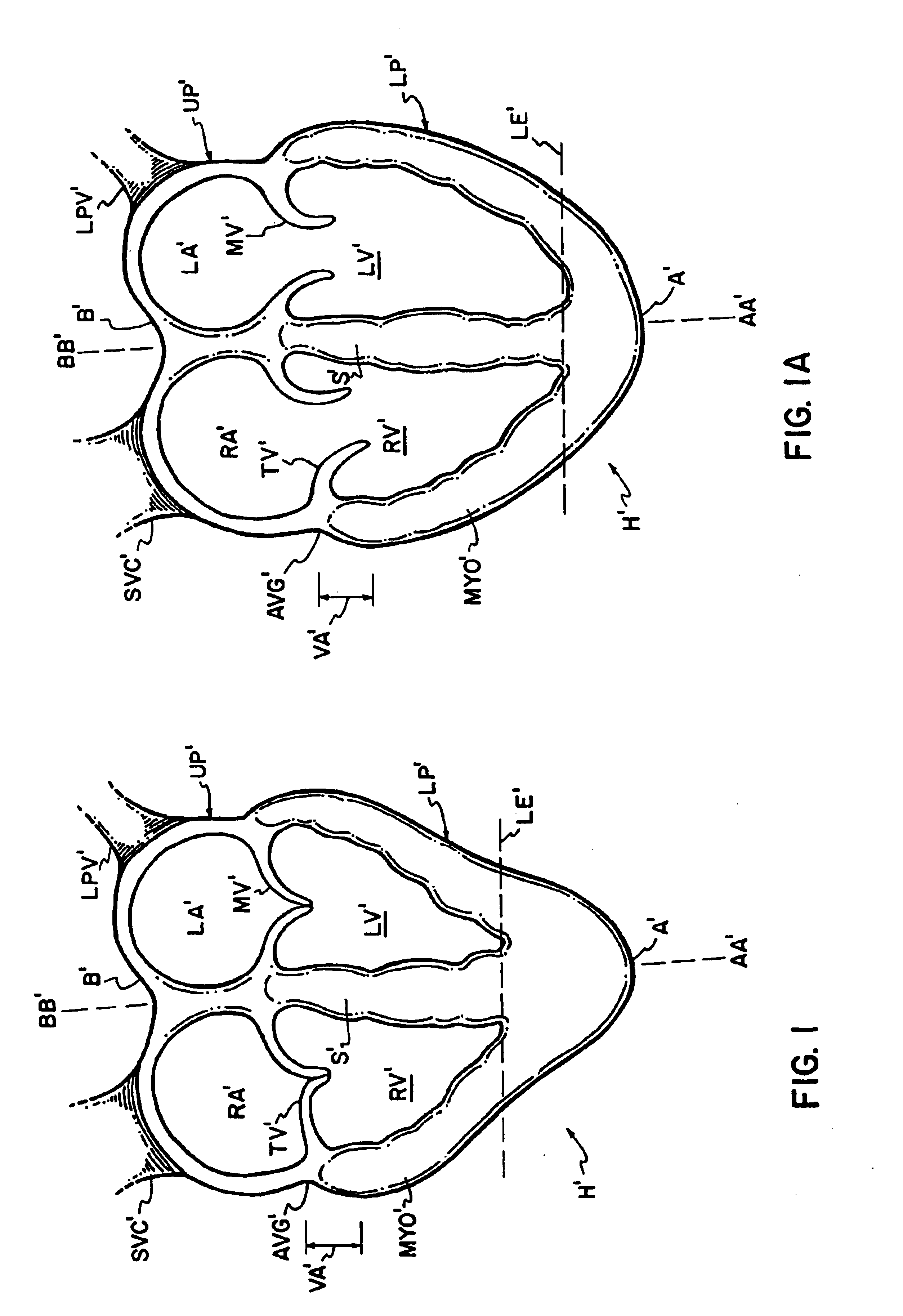 Cardiac disease treatment and device