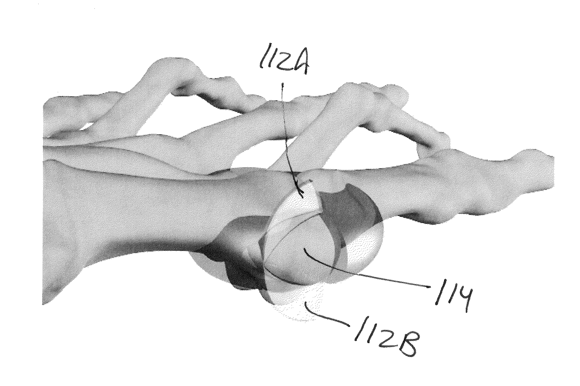 Methods and devices for treating hallux valgus