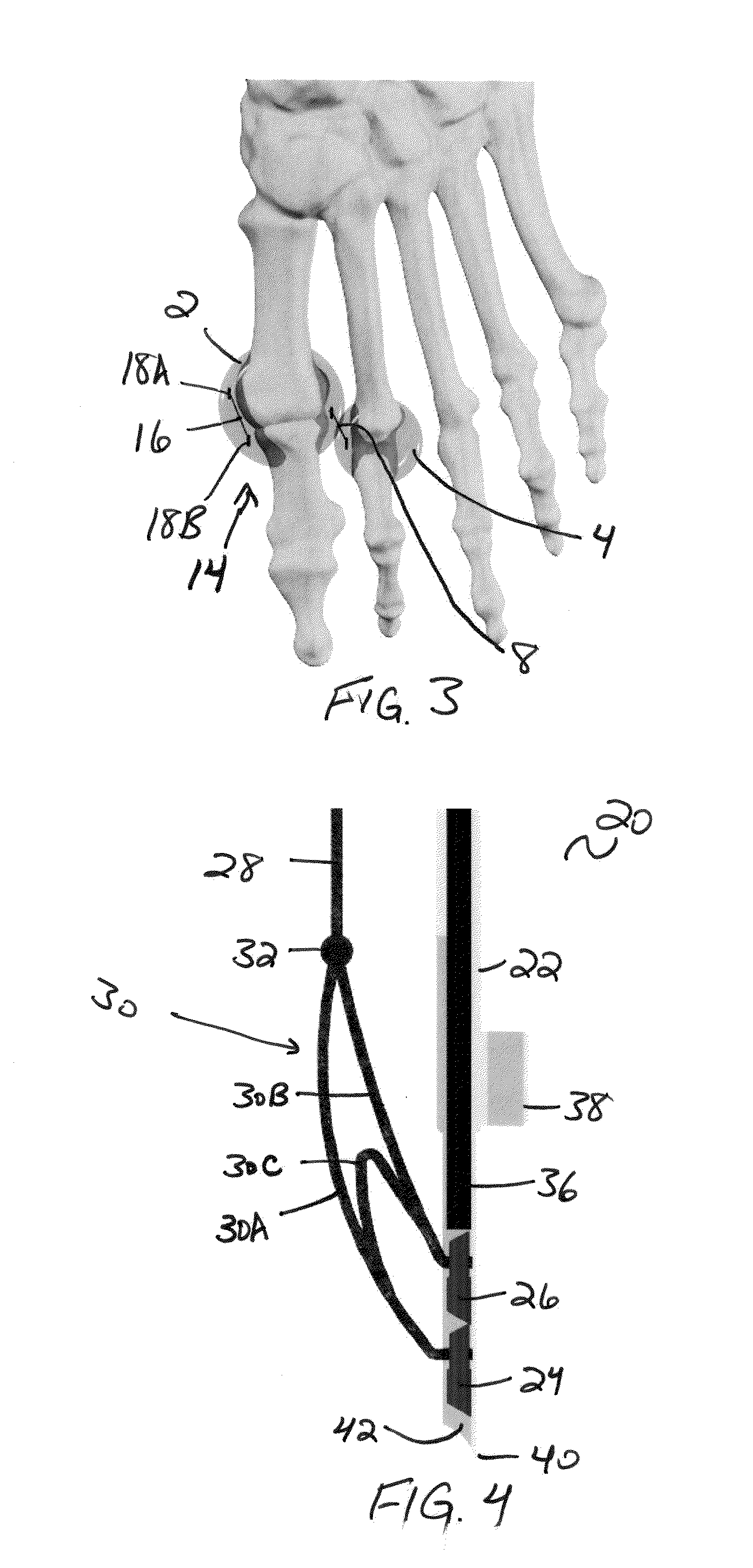 Methods and devices for treating hallux valgus