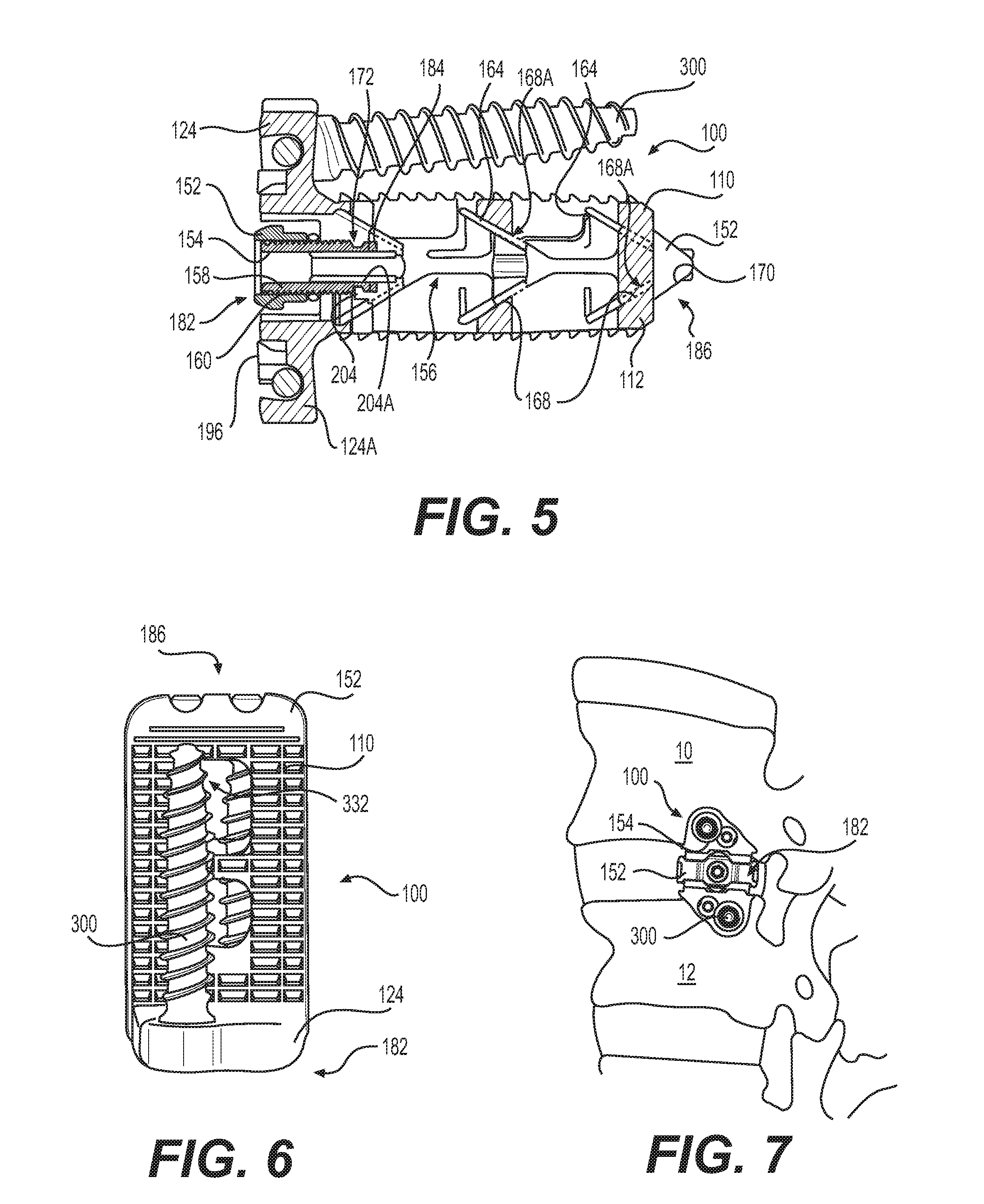 Expandable vertebral implant