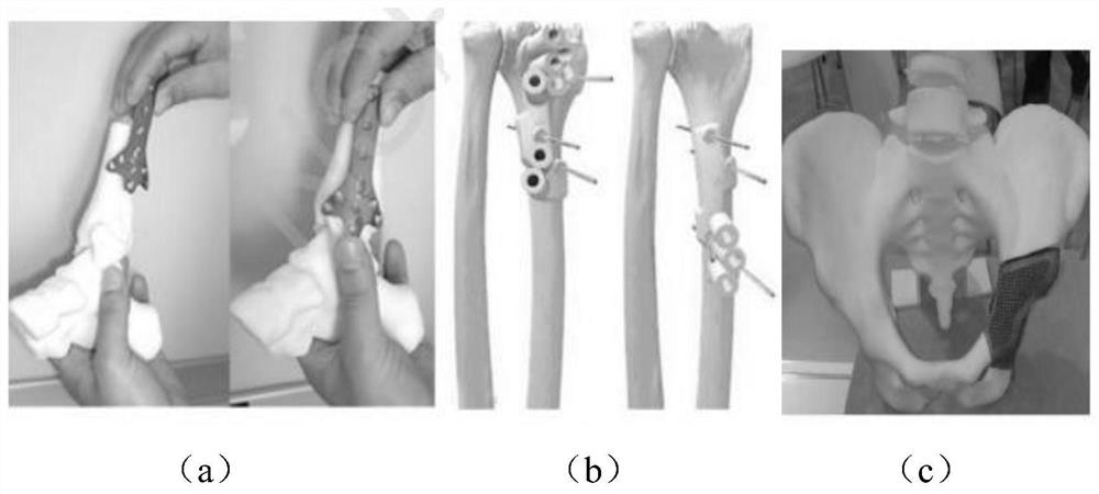 3D printing personalized orthopedic implant construction and biomechanical optimization processing method