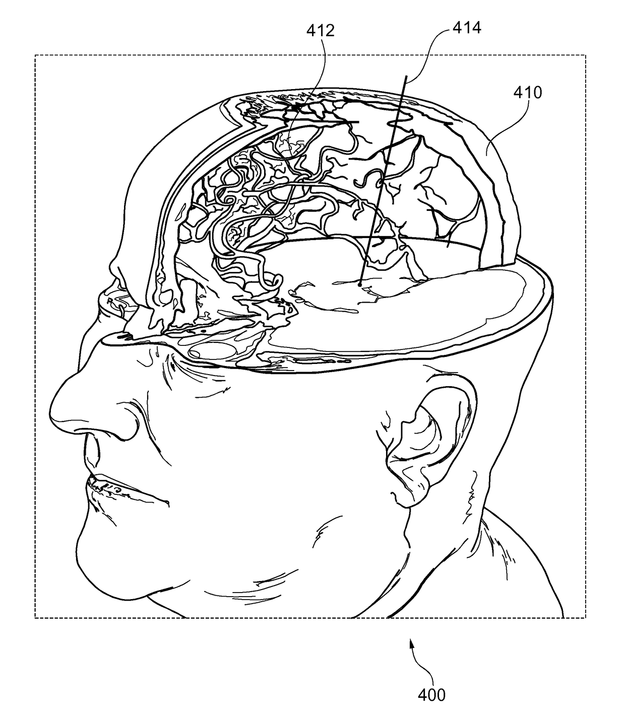 Tracking brain deformation during neurosurgery