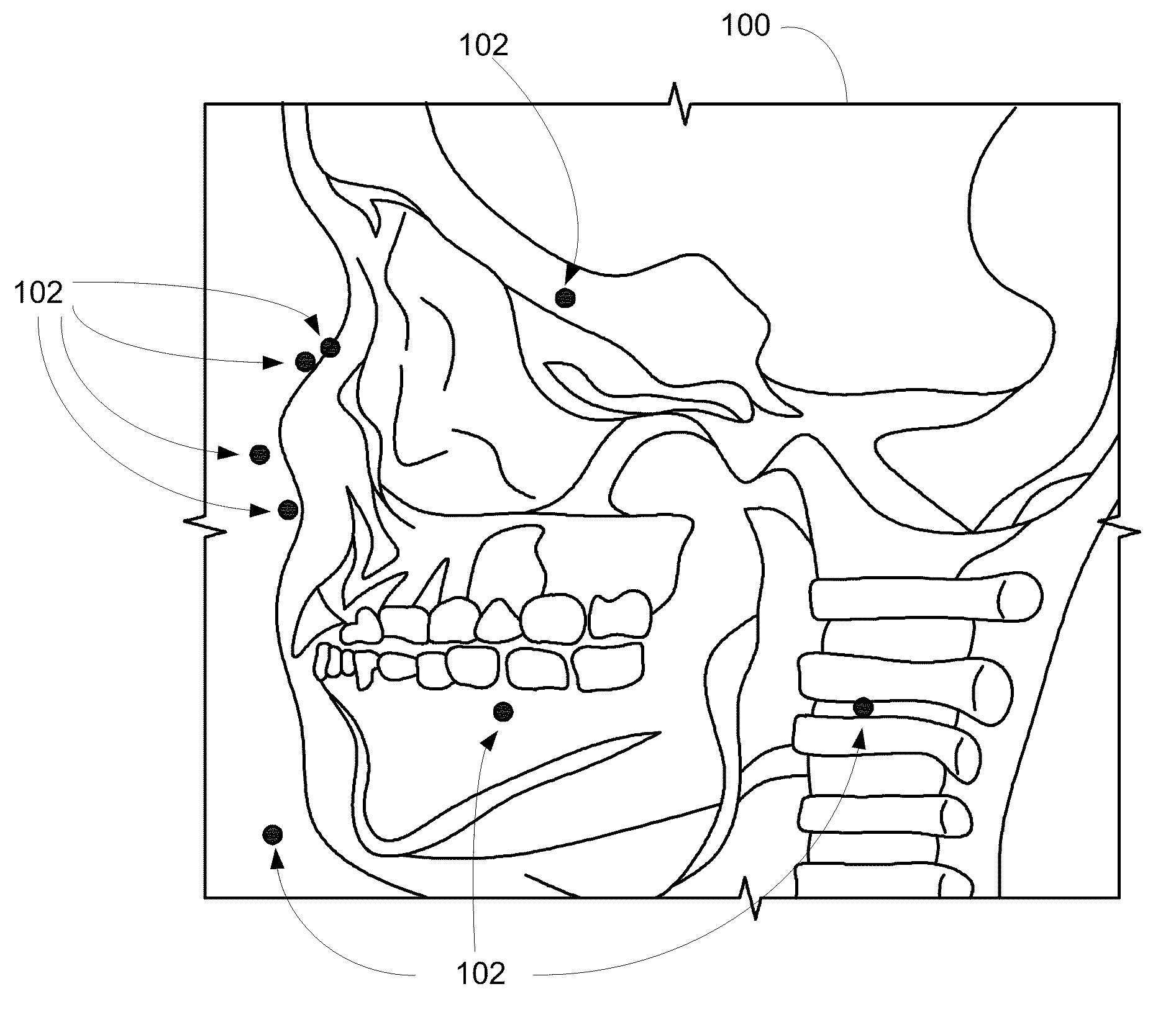 Method for tracking x-ray markers in serial ct projection images