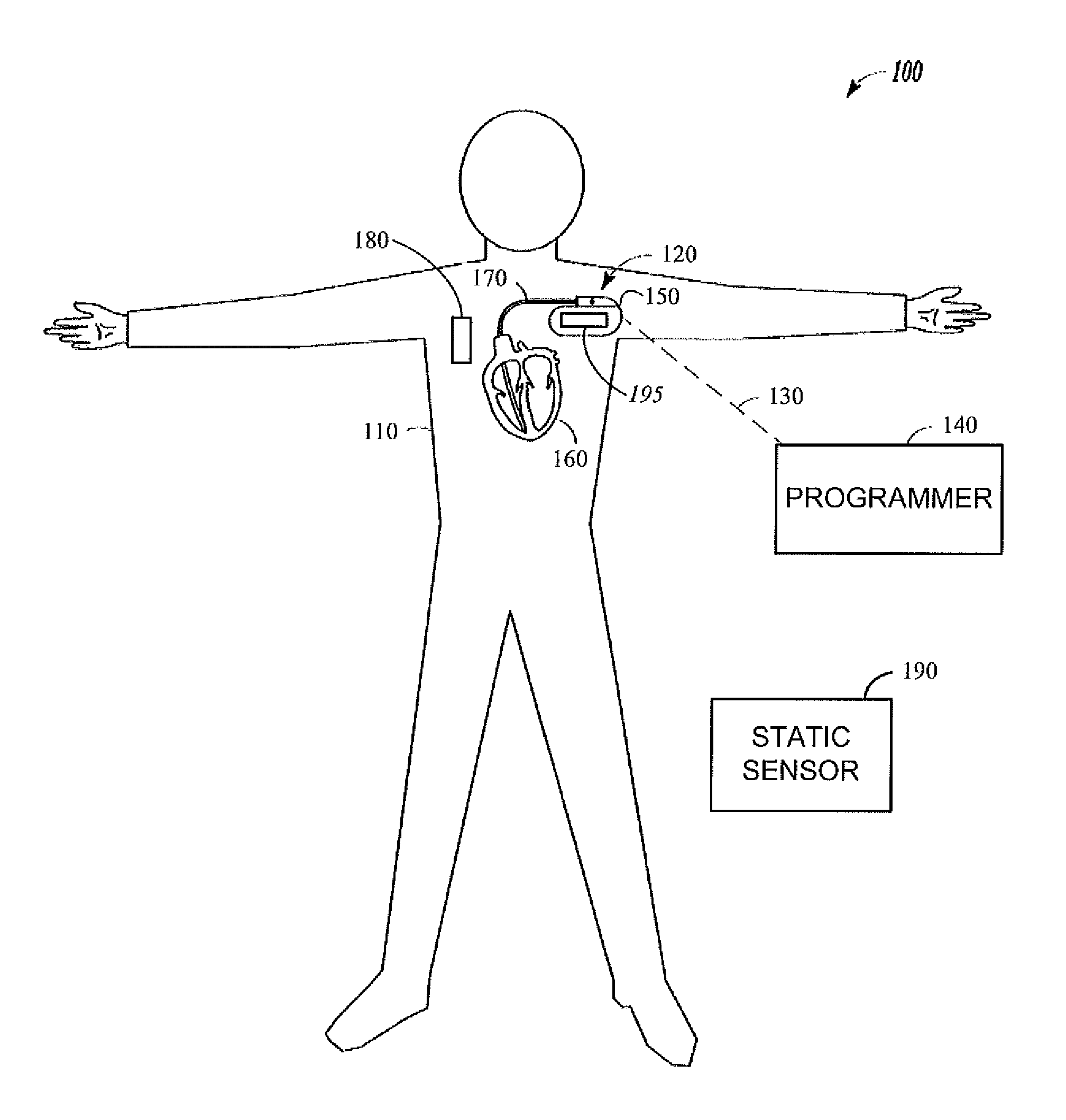 Detecting heart failure by monitoring the time seqence of physiological changes