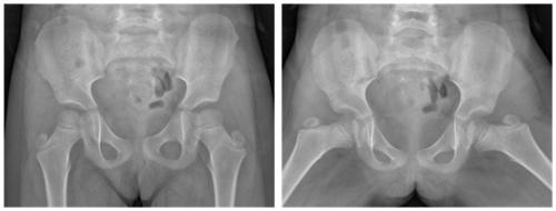 Children femoral head rotation center detection method