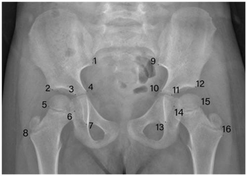 Children femoral head rotation center detection method