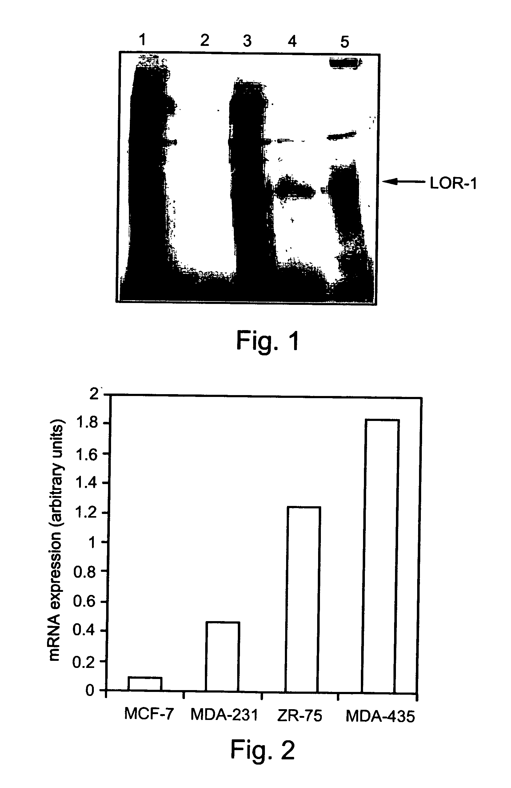 Pharmaceutical compositions and methods useful for modulating angiogenesis, inhibiting metastasis and tumor fibrosis, and assessing the malignancy of colon cancer tumors