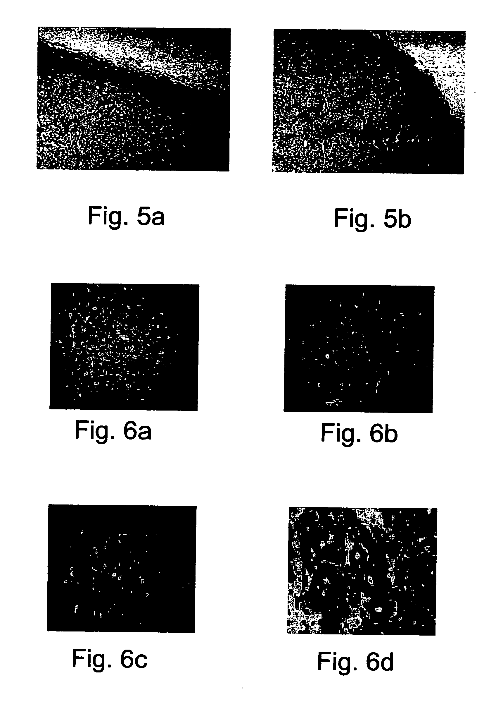 Pharmaceutical compositions and methods useful for modulating angiogenesis, inhibiting metastasis and tumor fibrosis, and assessing the malignancy of colon cancer tumors