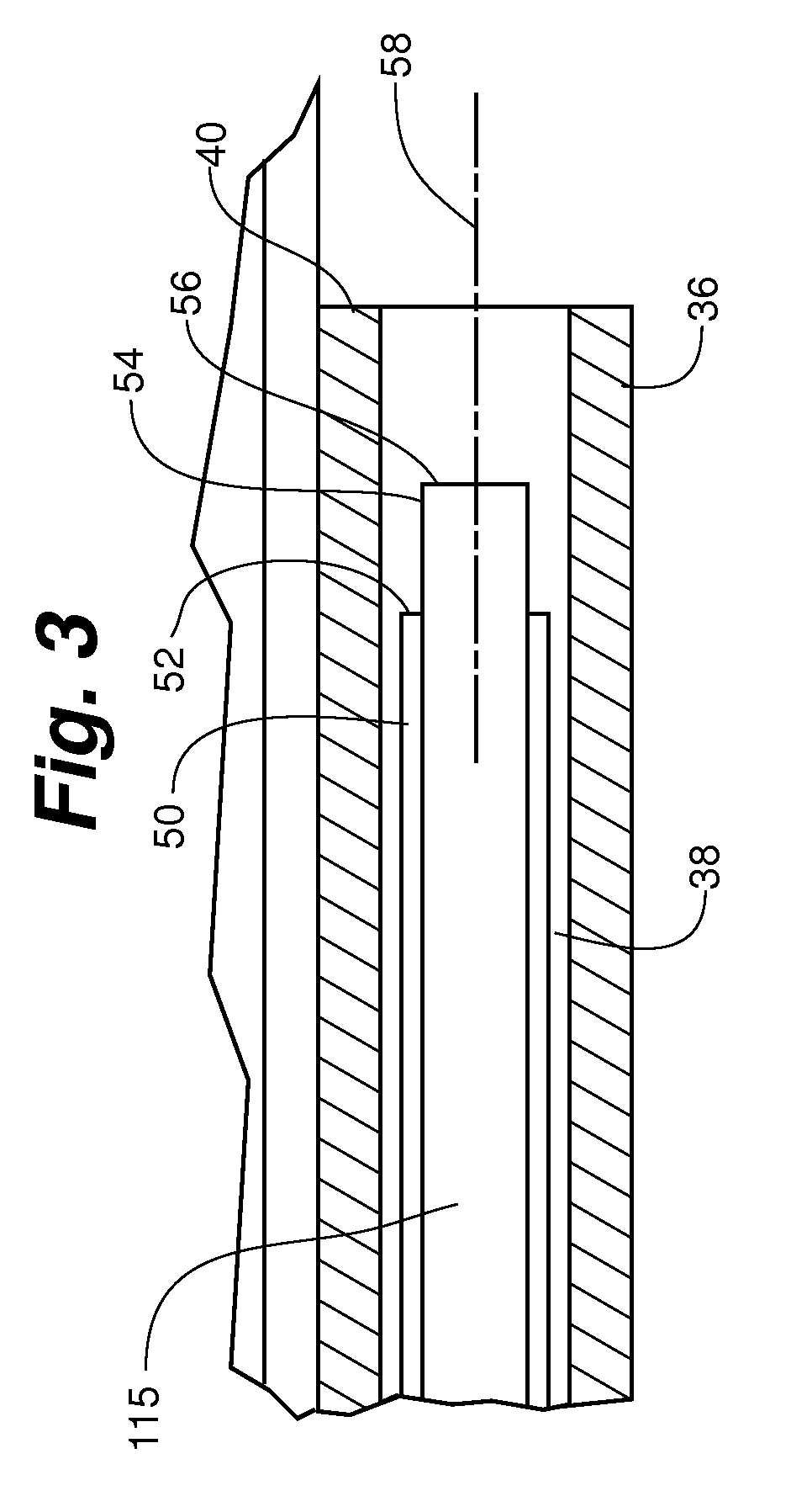 Laser energy device for soft tissue removal