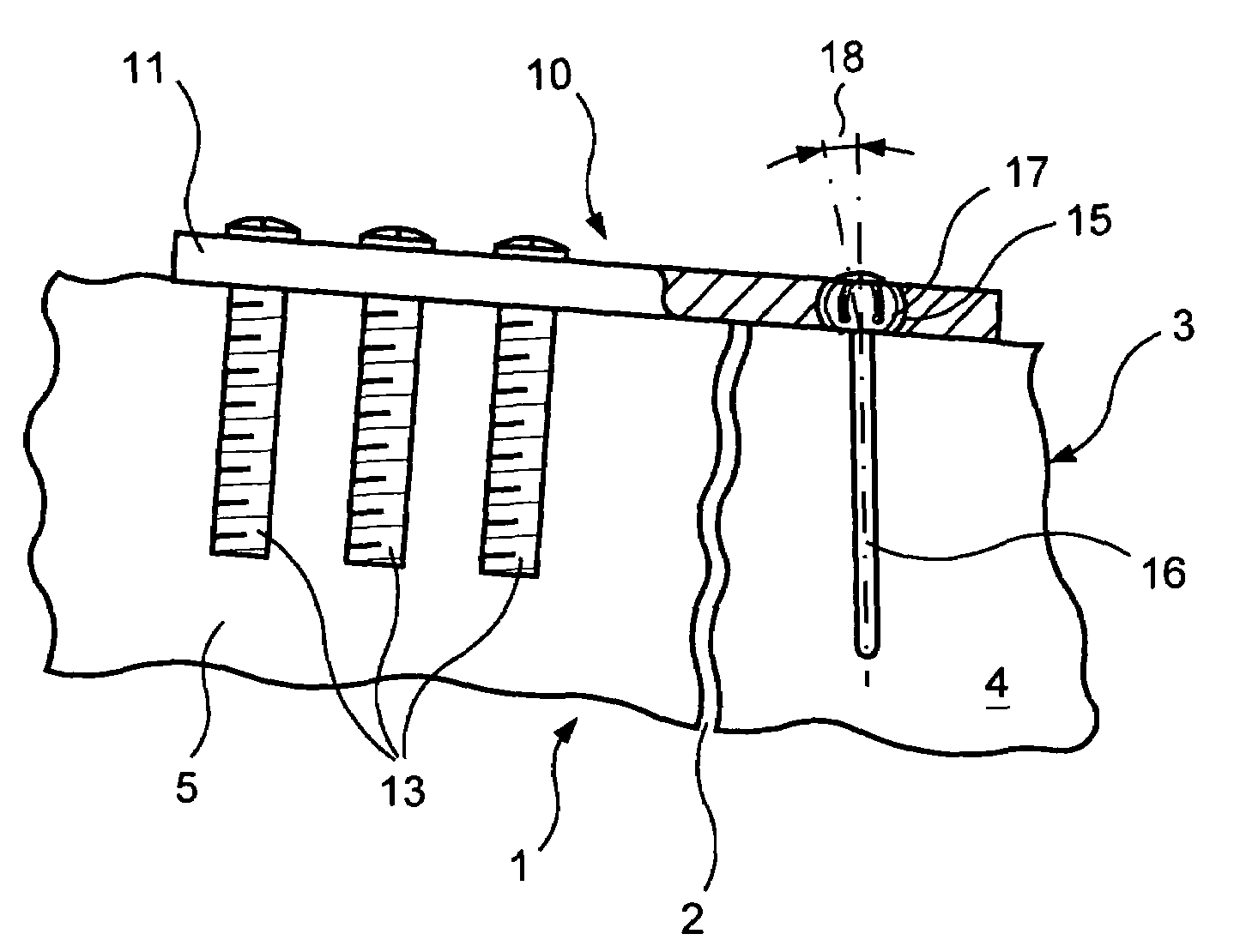 Fracture fixation system