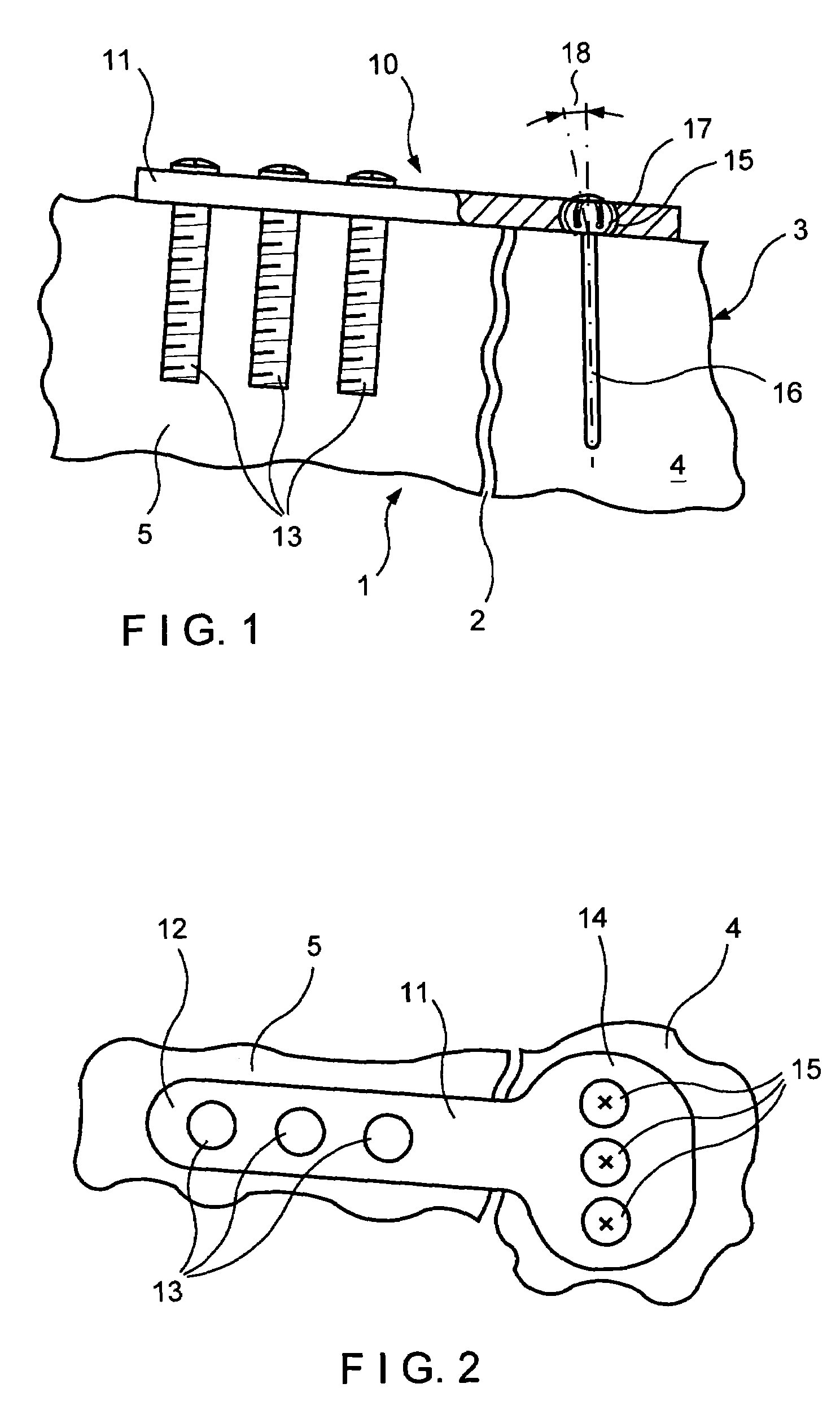 Fracture fixation system