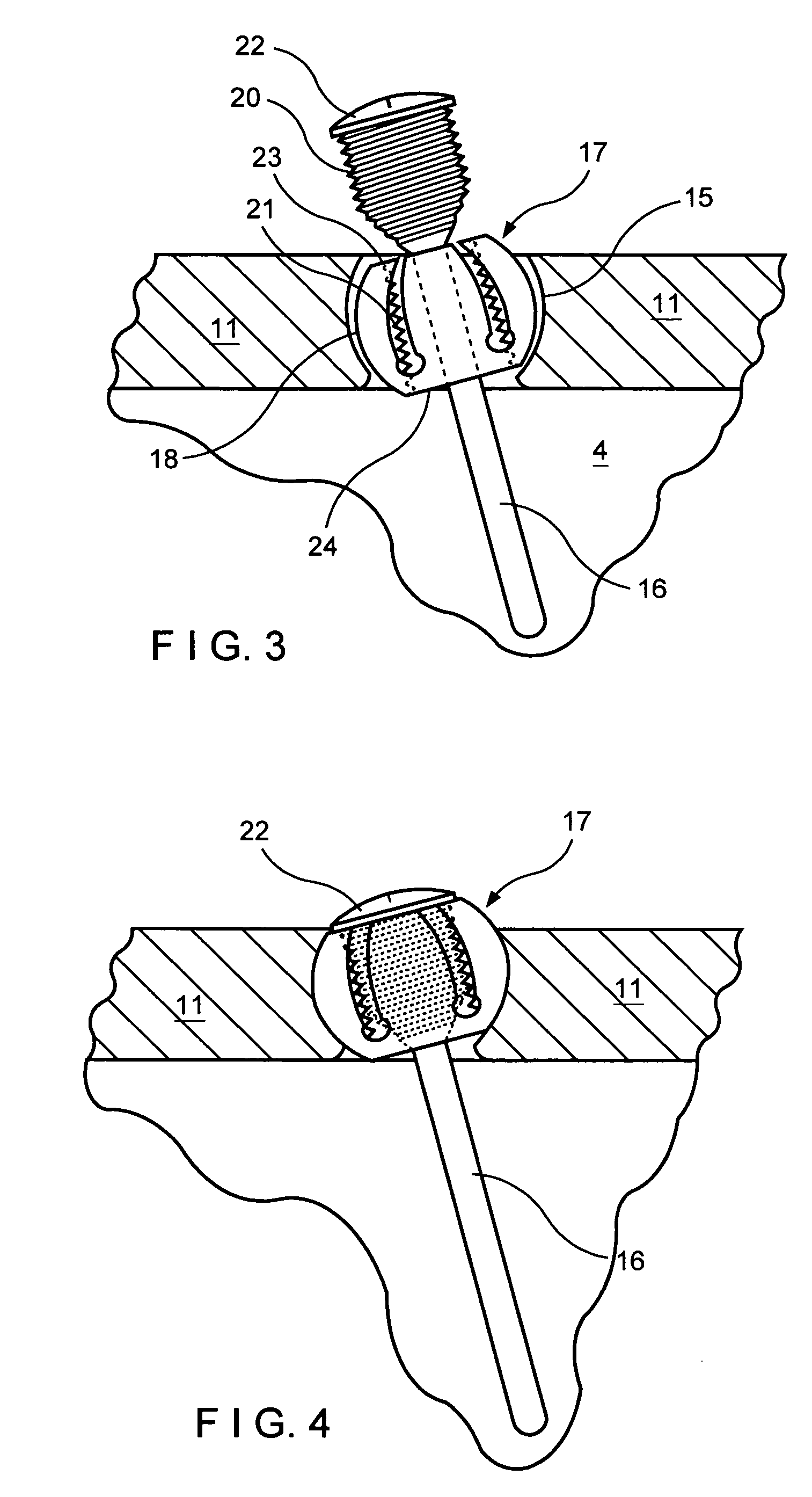 Fracture fixation system