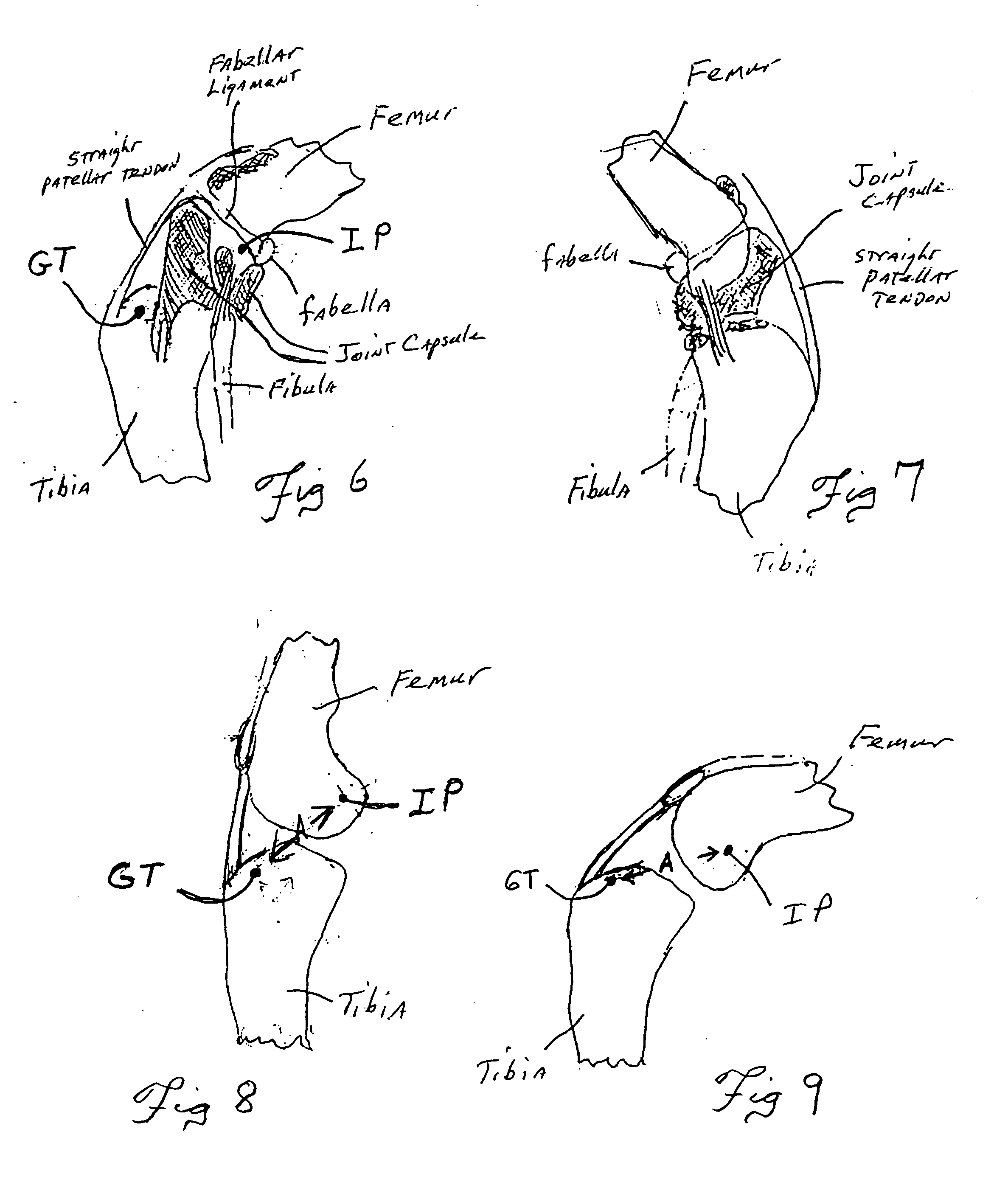 Extracapsular surgical procedure for repair of anterior cruciate ligament rupture and surgical referencing instrument therefor