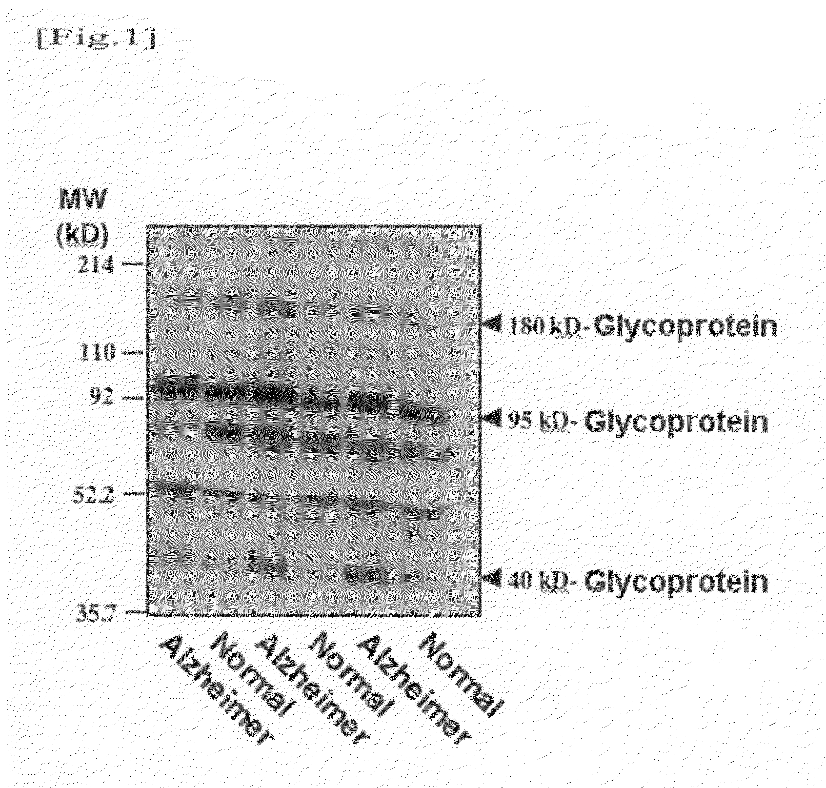 Method for diagnosing alzheimer's disease using serum glycoprotein as biomarker