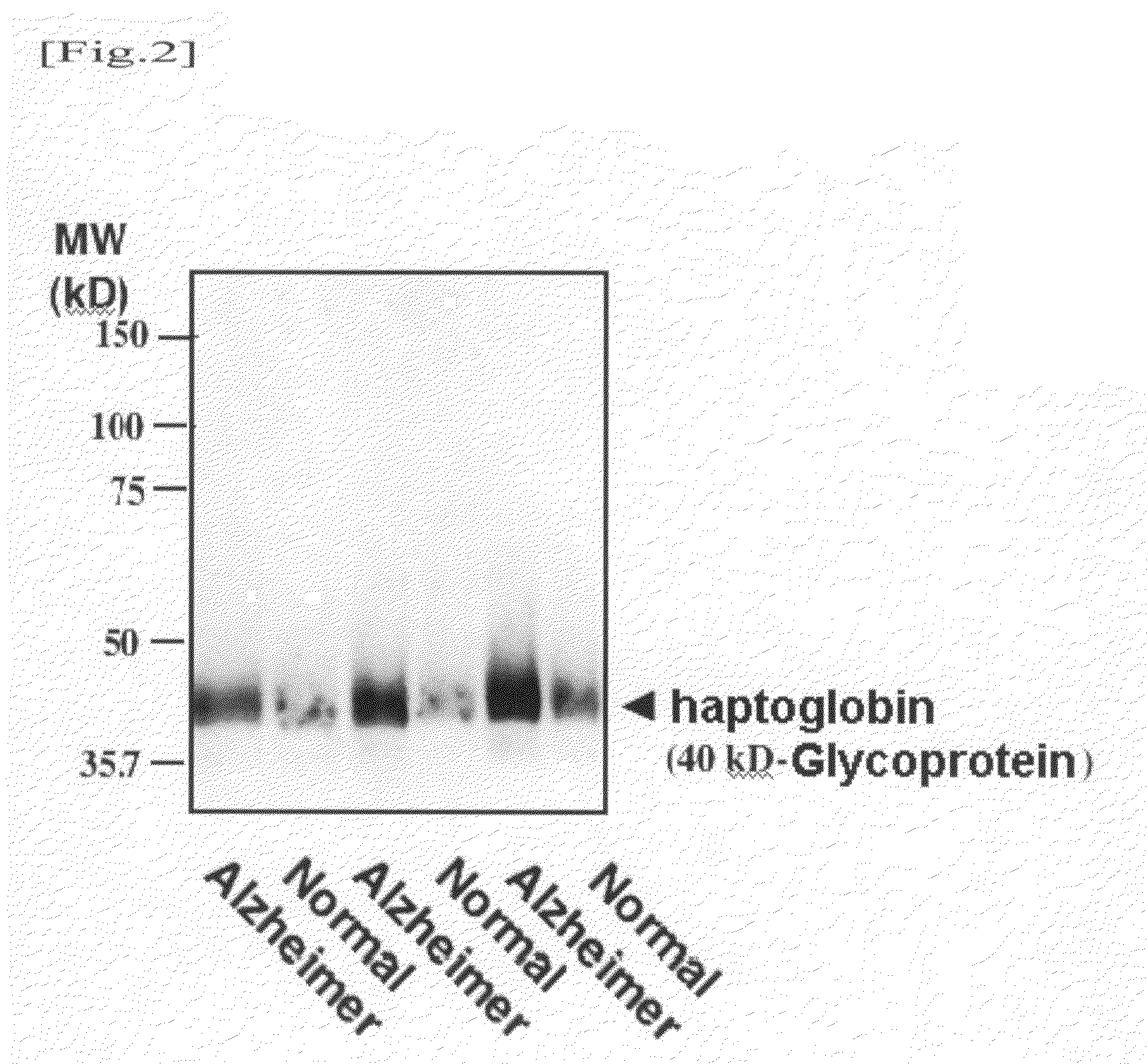 Method for diagnosing alzheimer's disease using serum glycoprotein as biomarker