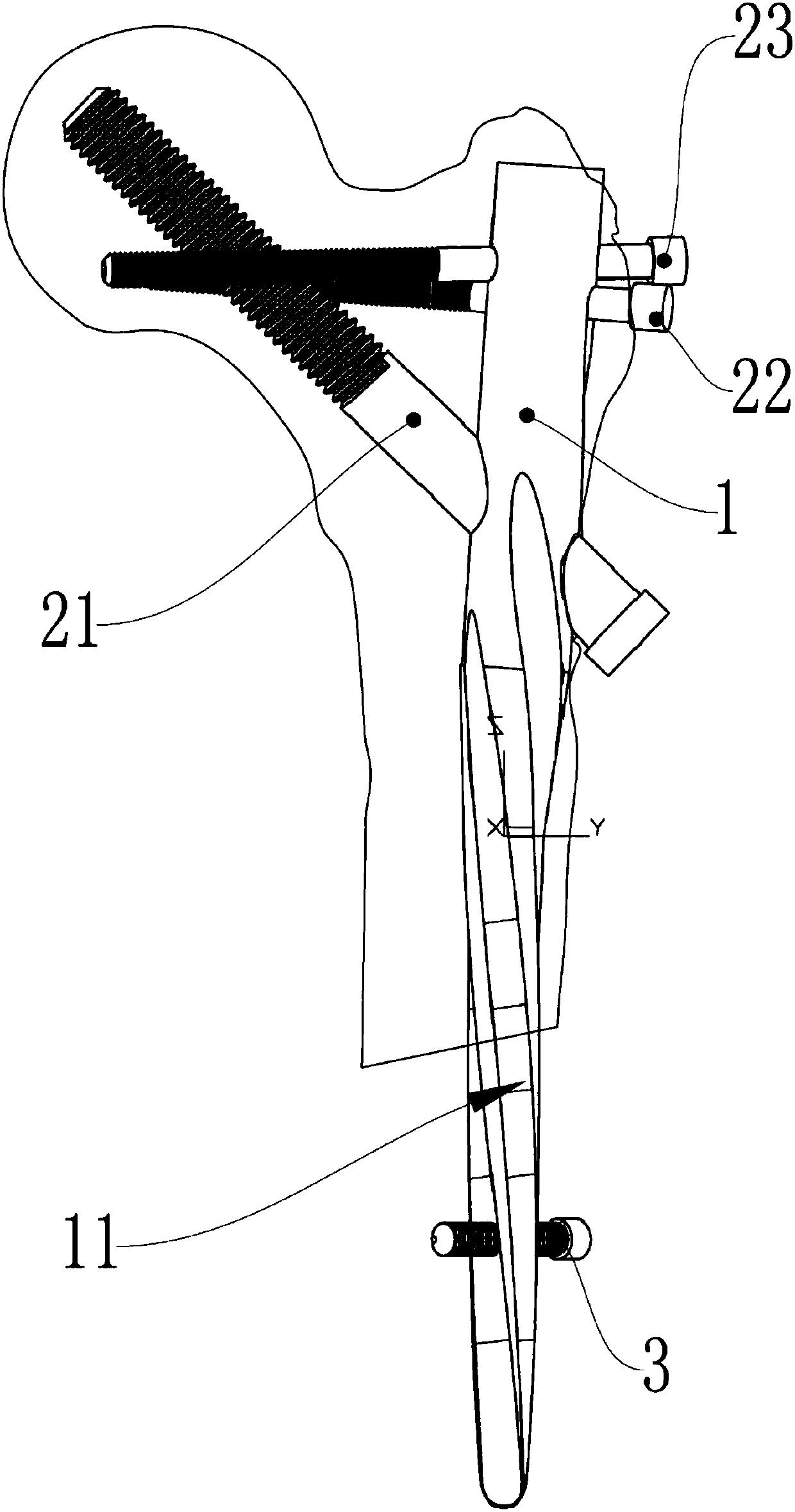 Unreamed intramedullary nail used for treating femur fracture and having minimally invasive and supporting functions