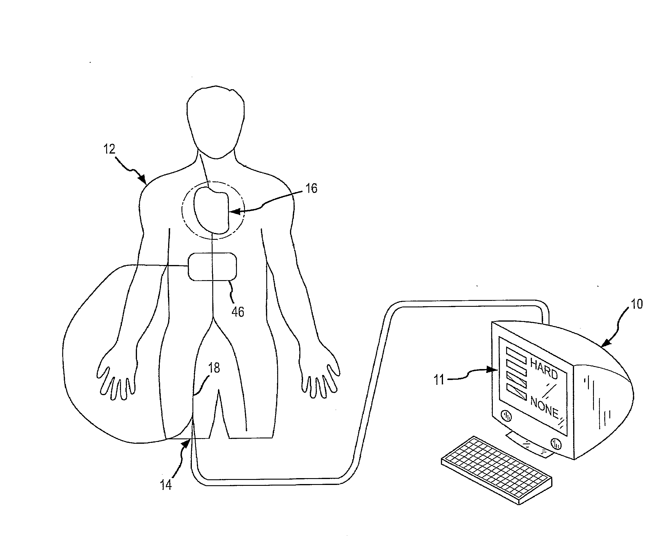 Method for Displaying Catheter Electrode-Tissue Contact in Electro-Anatomic Mapping and Navigation System