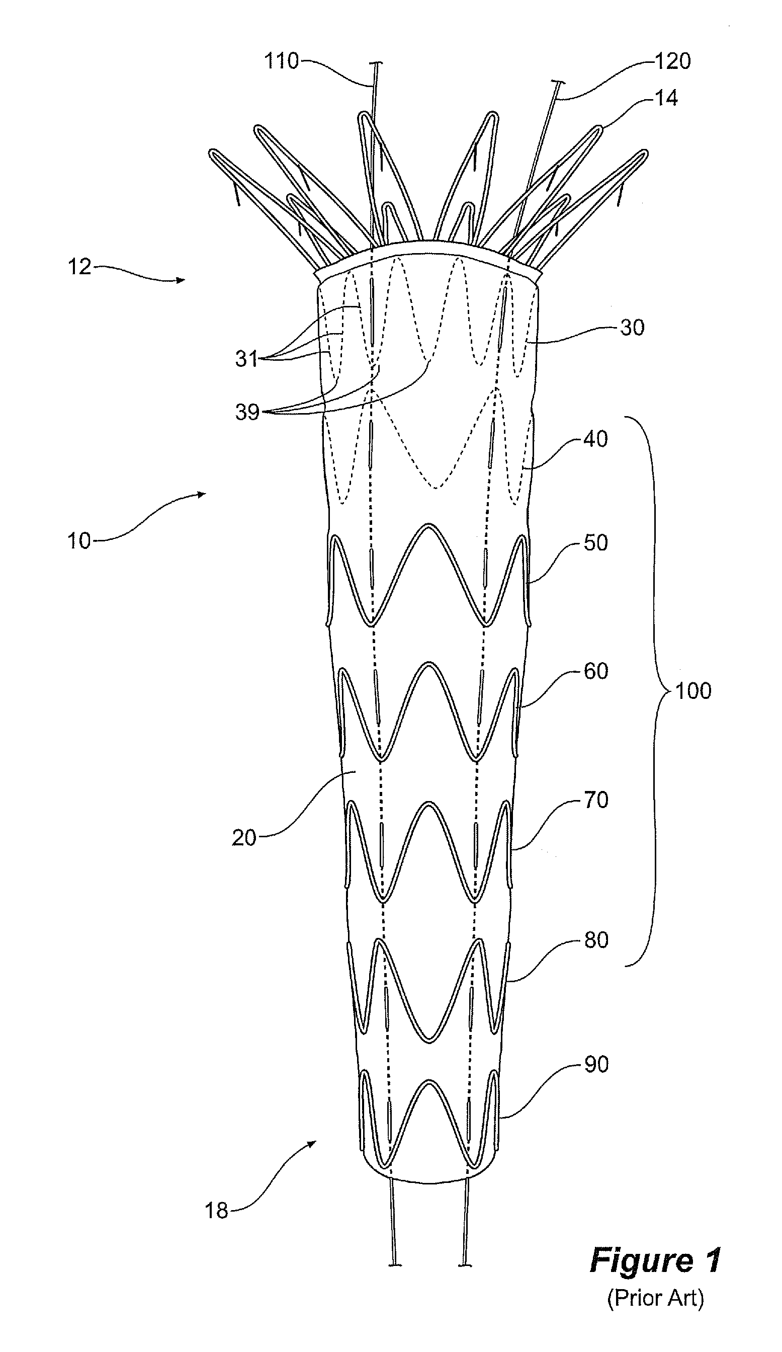 Assembly of stent grafts with diameter reducing ties