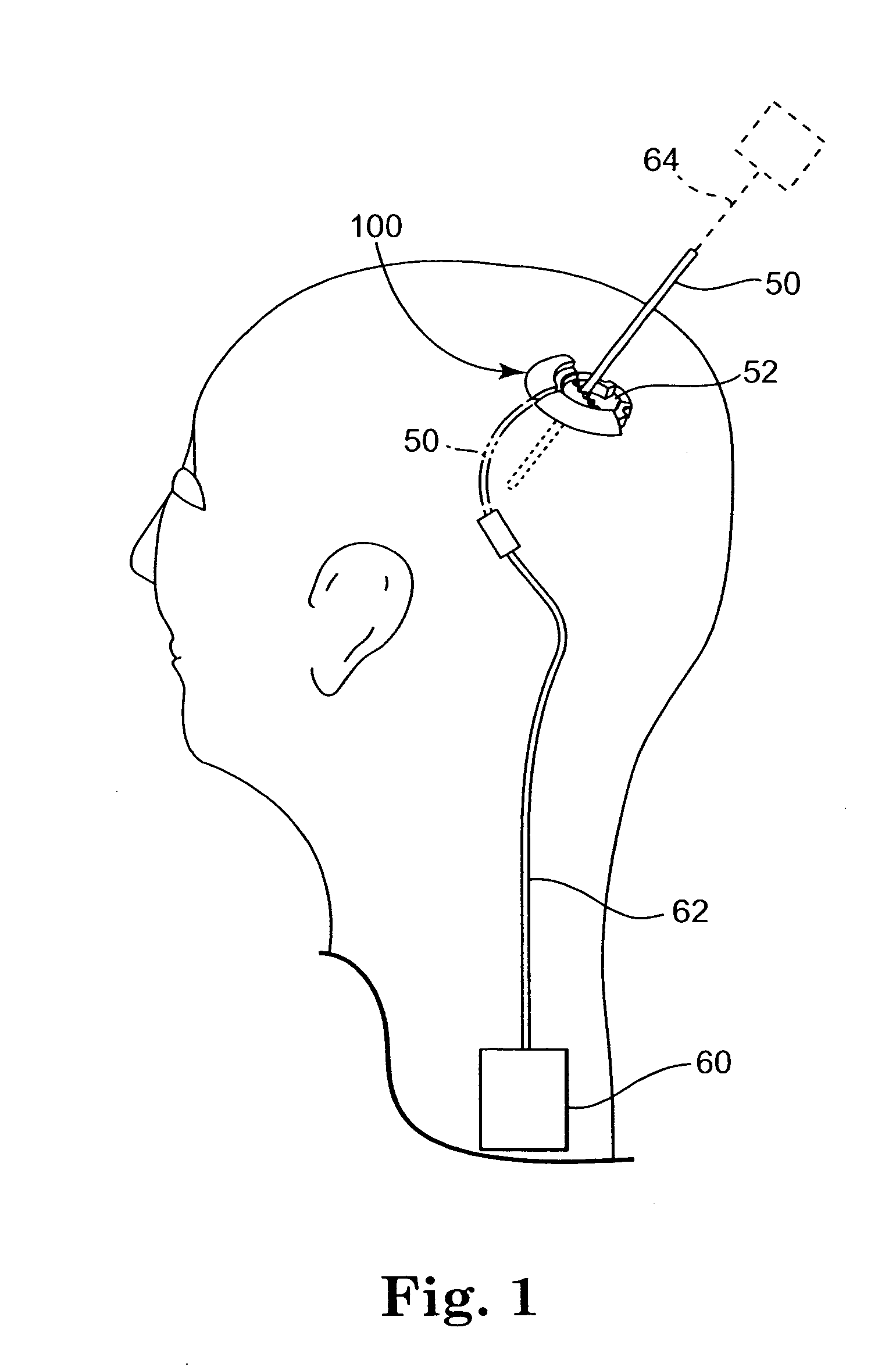 Methods and apparatus for securing a therapy delivery device within a burr hole