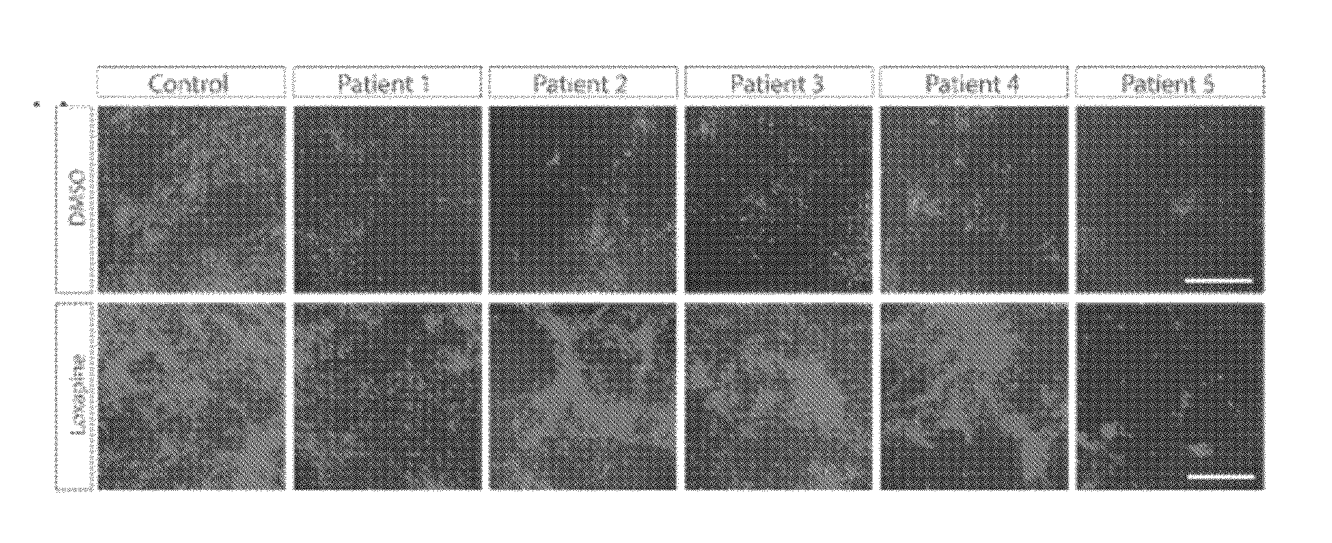 Schizophrenia methods and compositions